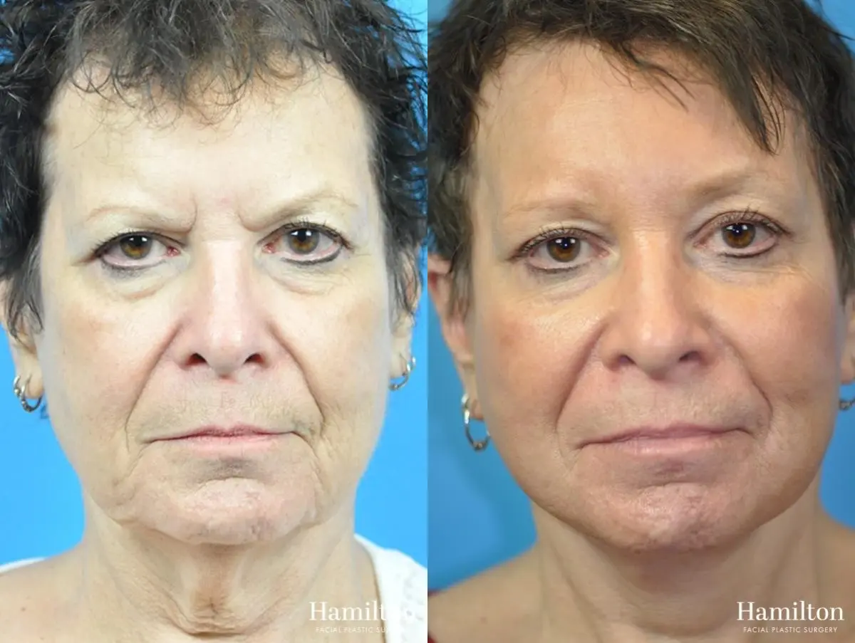 Facelift: Patient 28 - Before and After 1