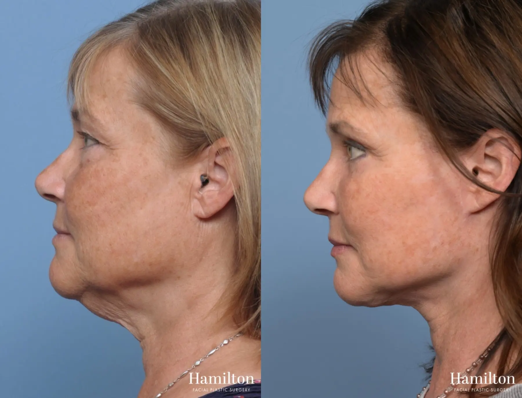 Facelift: Patient 14 - Before and After 4