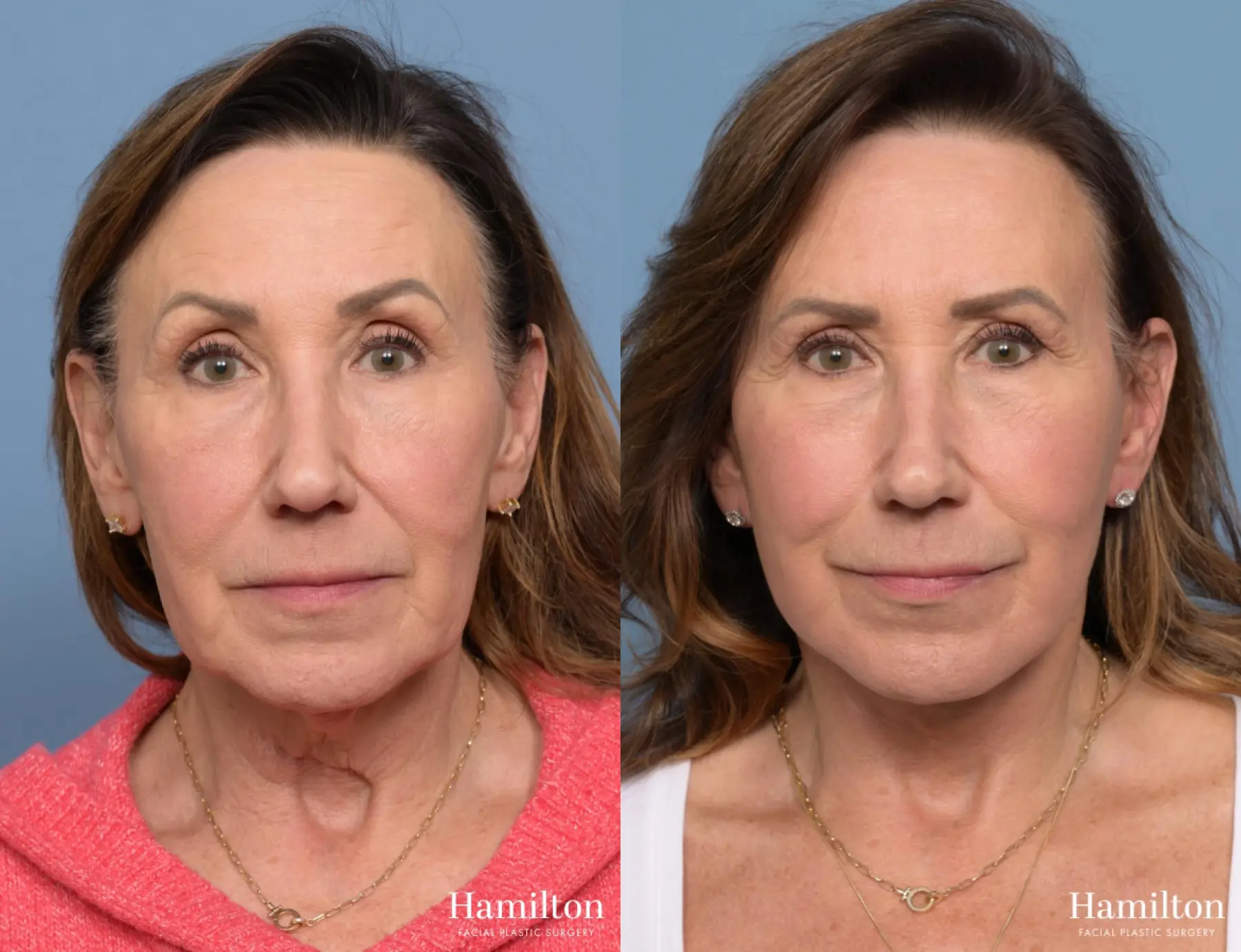 Facelift: Patient 9 - Before and After 3