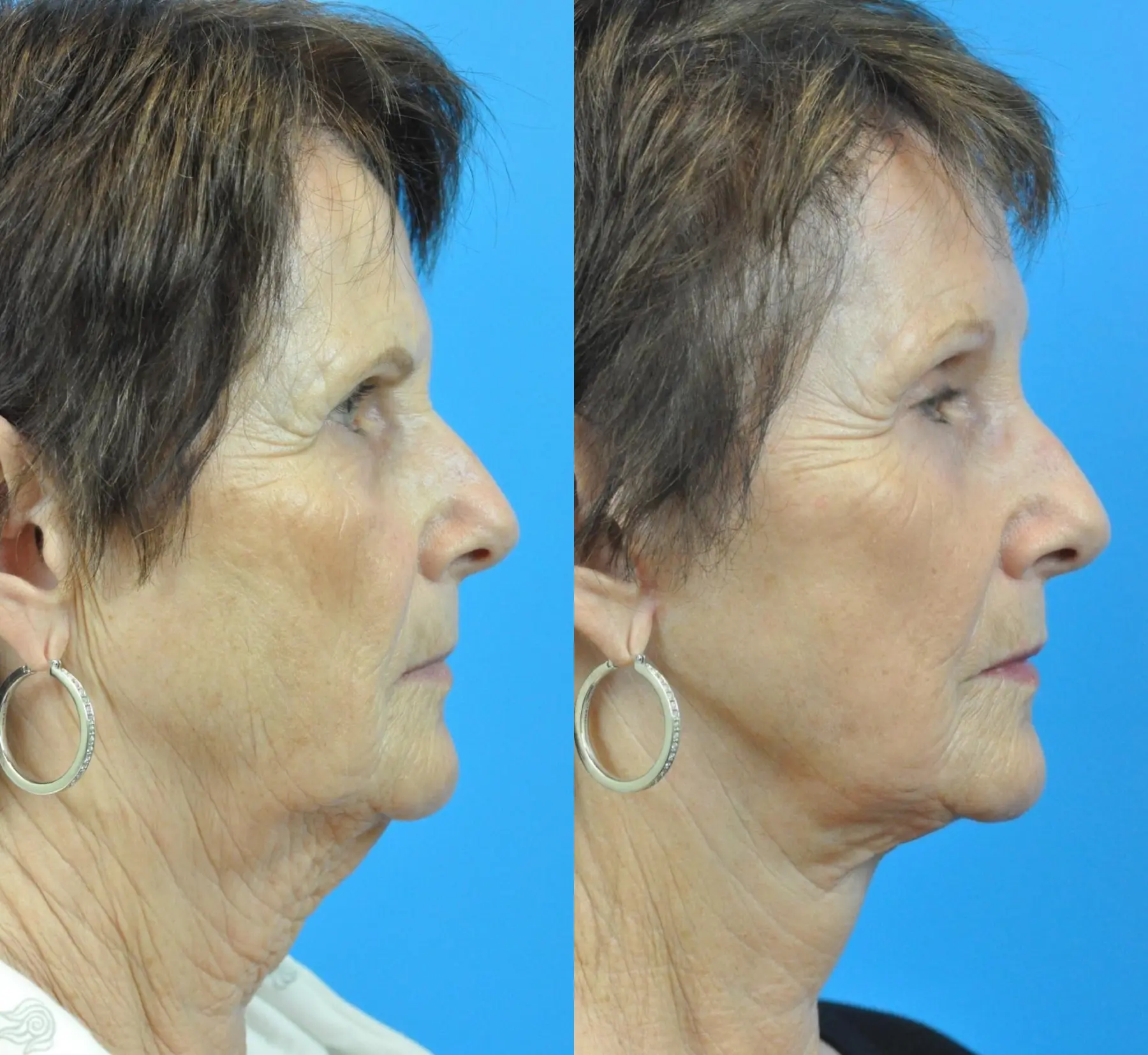 Facelift: Patient 32 - Before and After 2