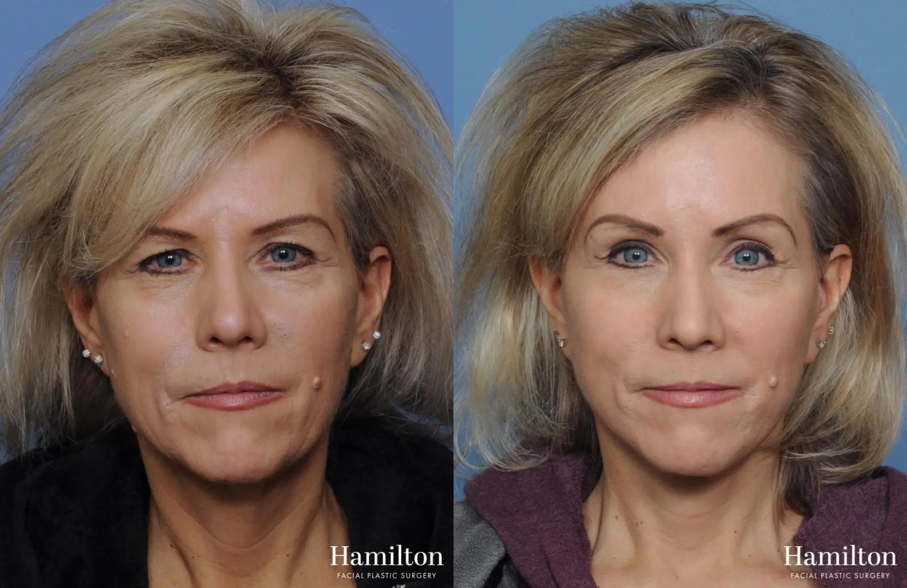 Facelift: Patient 3 - Before and After 3