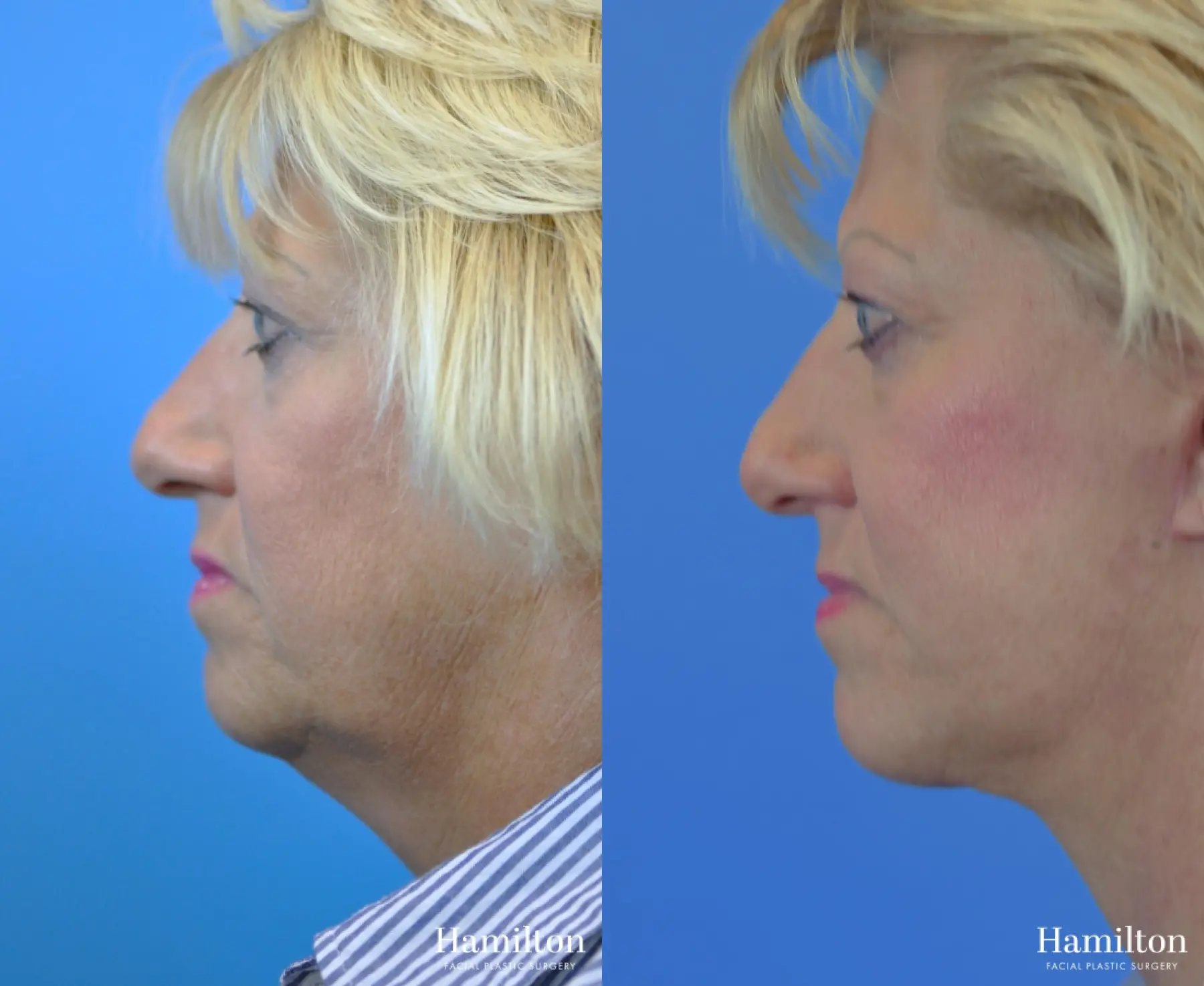 Facelift: Patient 34 - Before and After 2