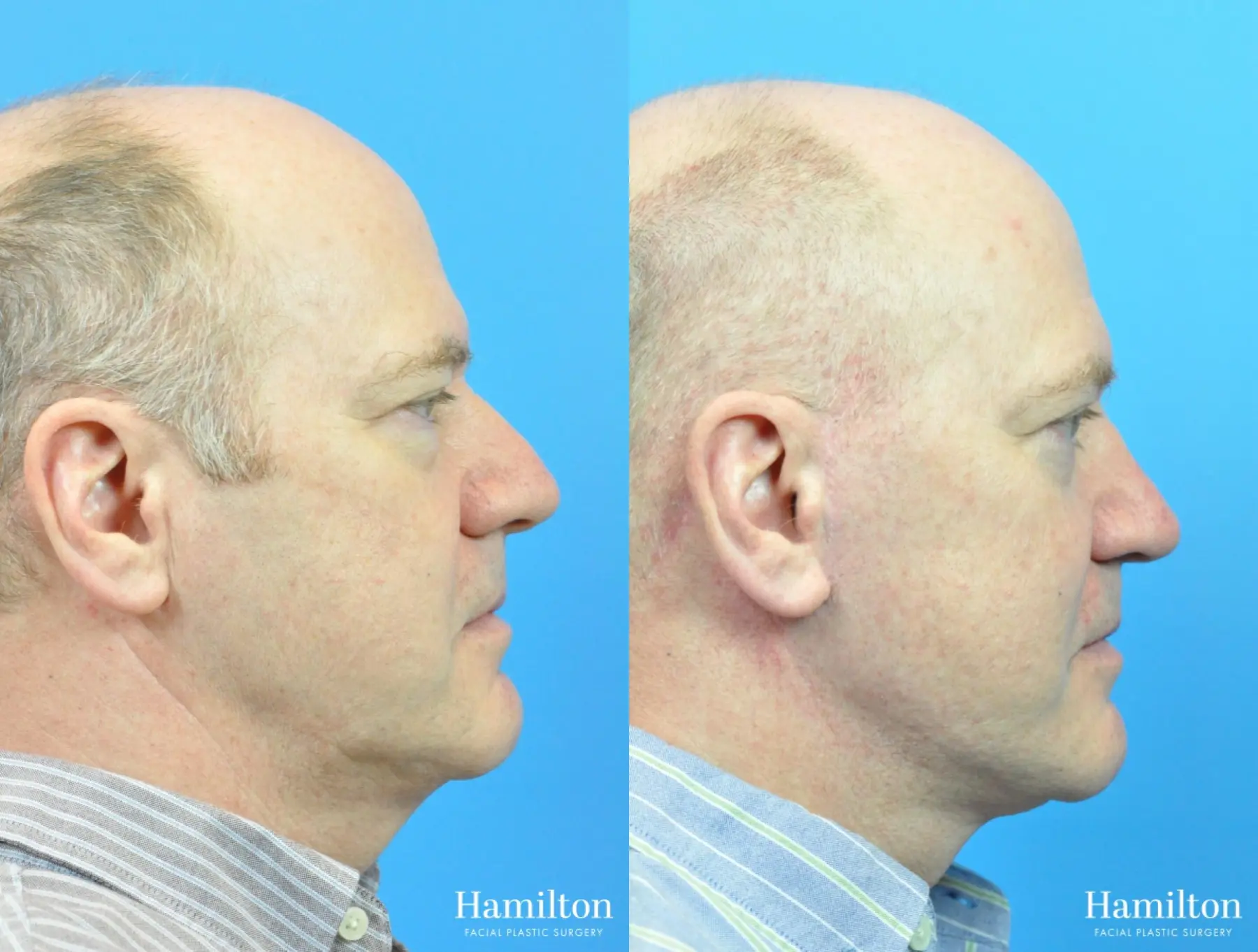 Facelift: Patient 33 - Before and After 1