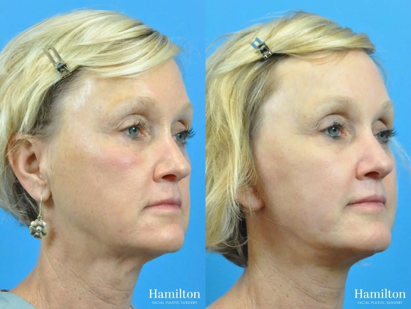 Facelift: Patient 25 - Before and After 2