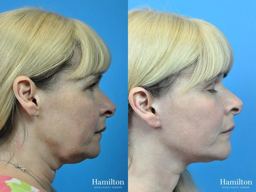 Facelift: Patient 22 - Before and After 3