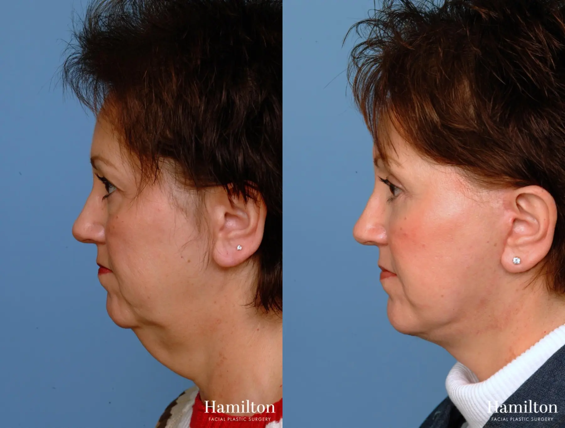 Facelift: Patient 13 - Before and After 1