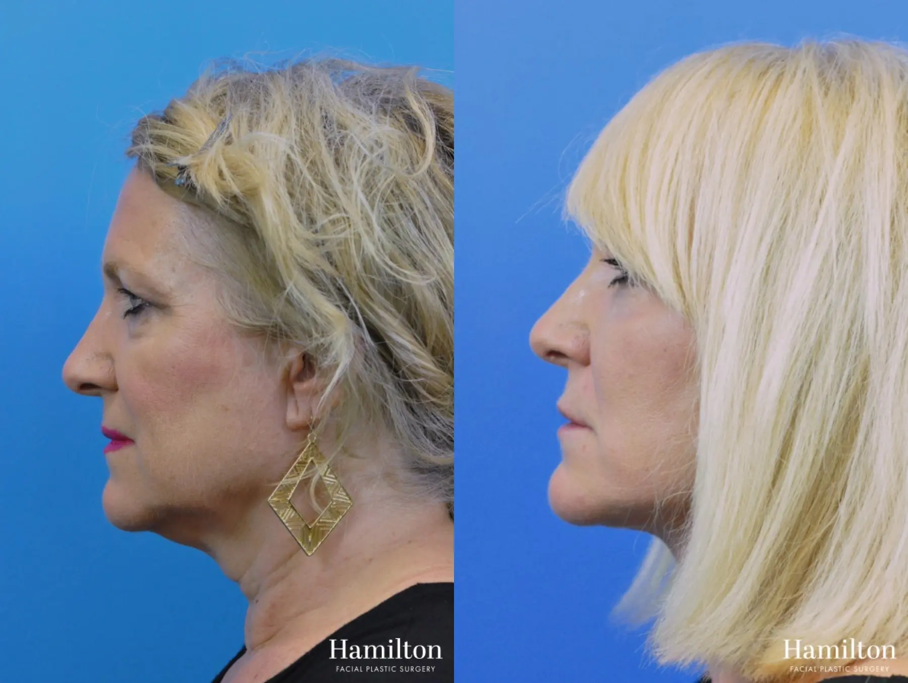 Facelift: Patient 10 - Before and After 3