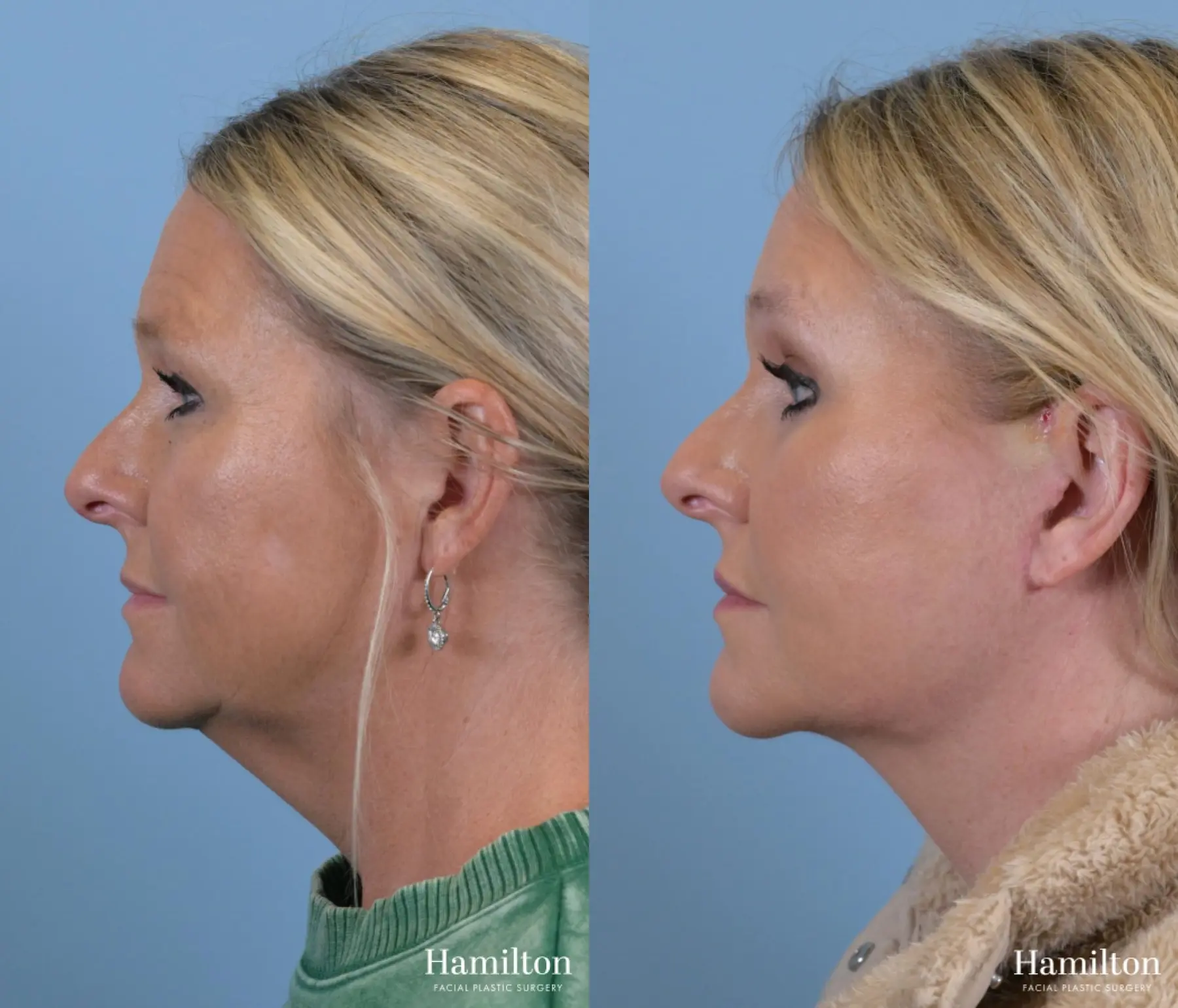 Facelift: Patient 3 - Before and After 1