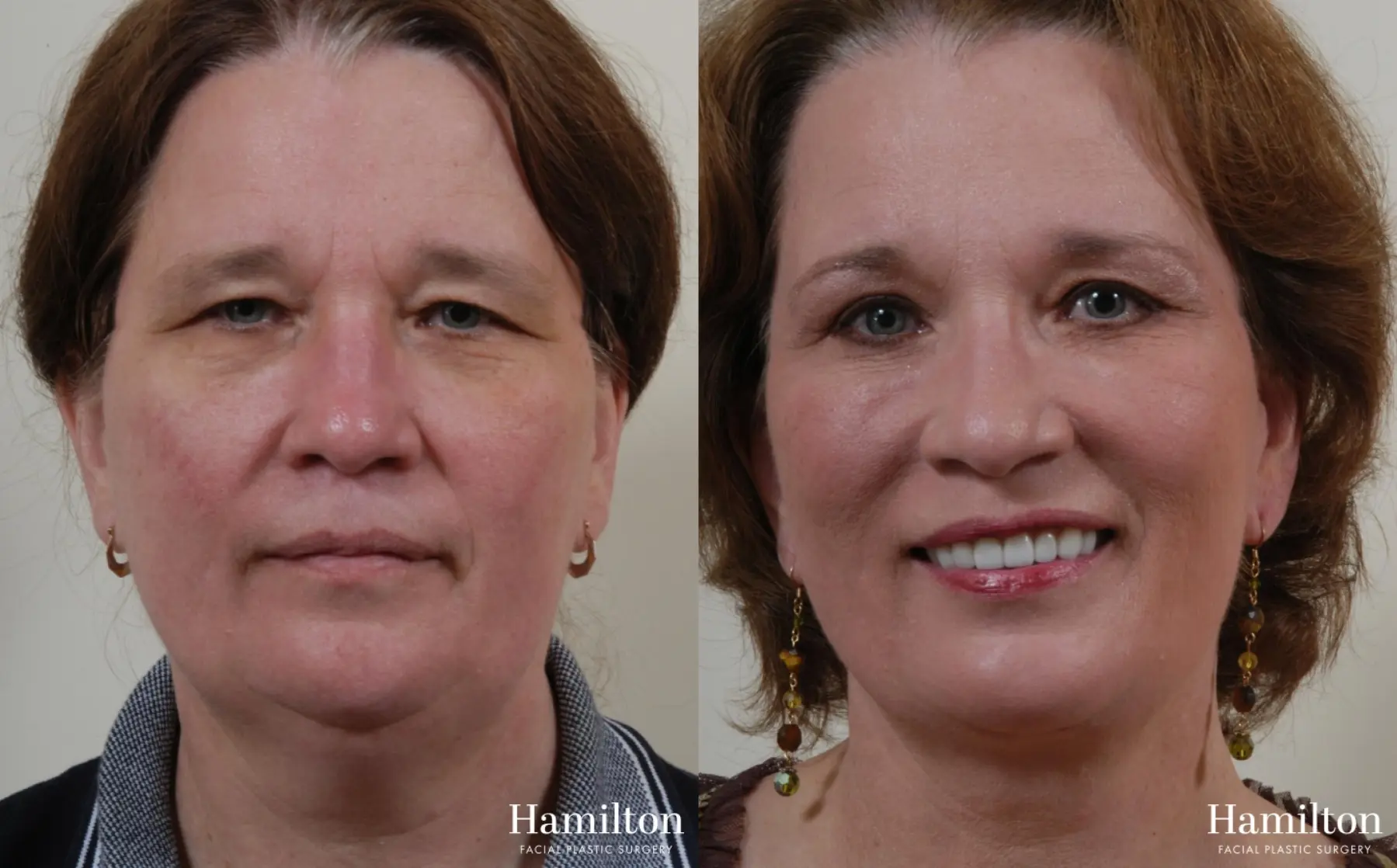 Facelift: Patient 6 - Before and After 3