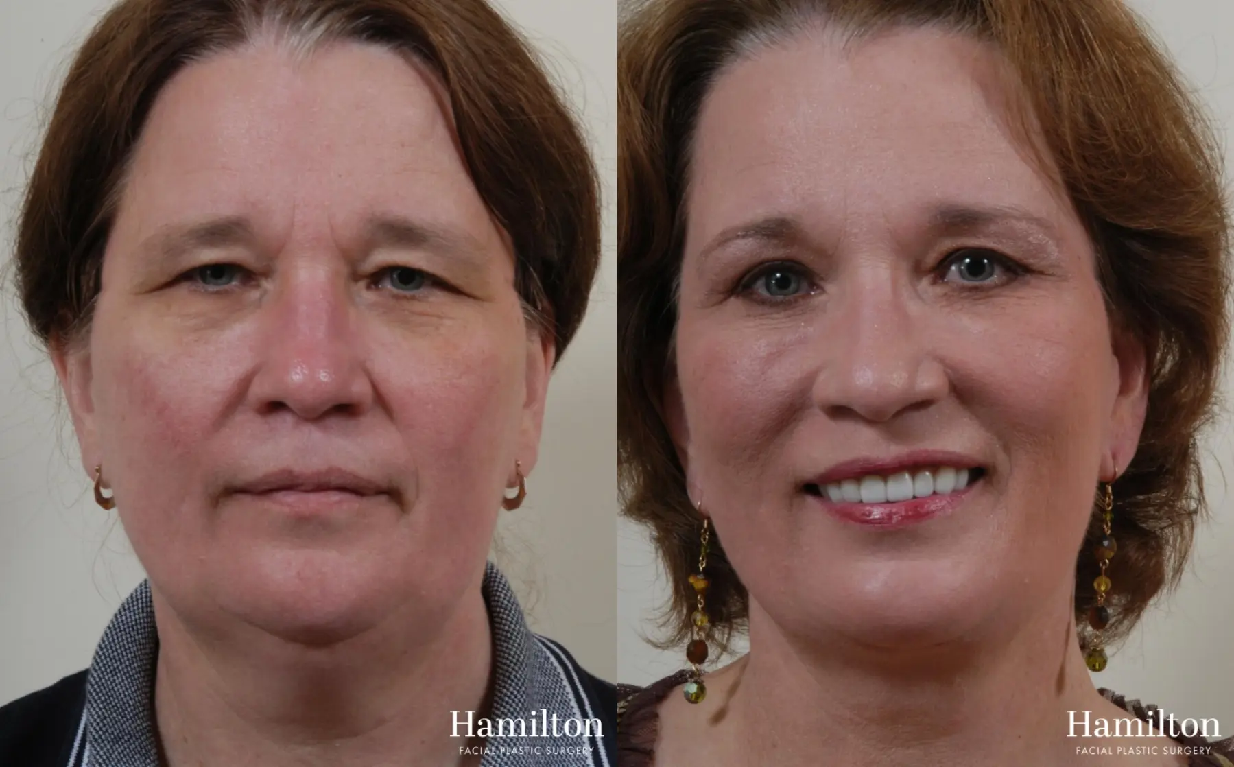 Facelift: Patient 16 - Before and After 3
