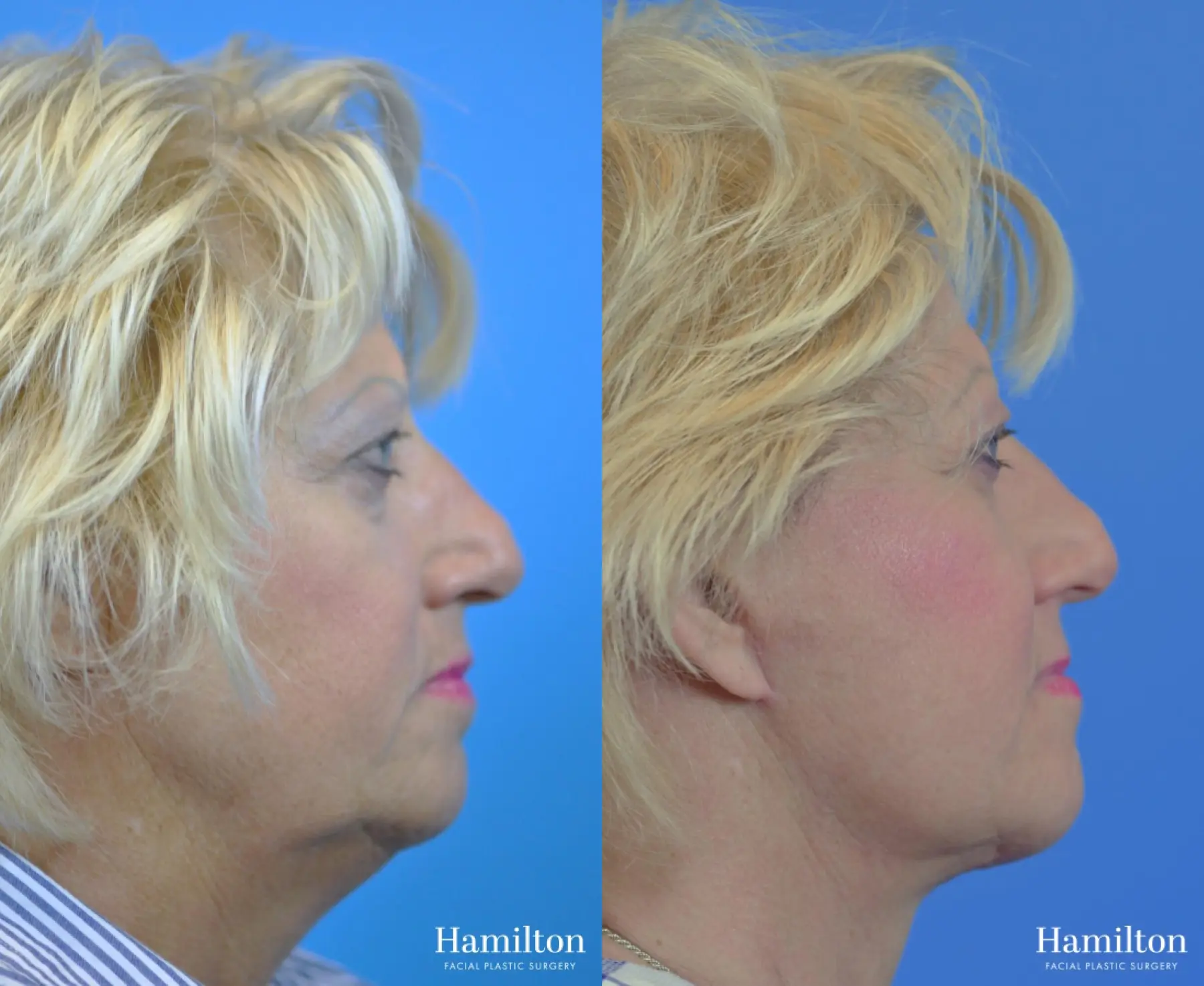 Facelift: Patient 23 - Before and After 1