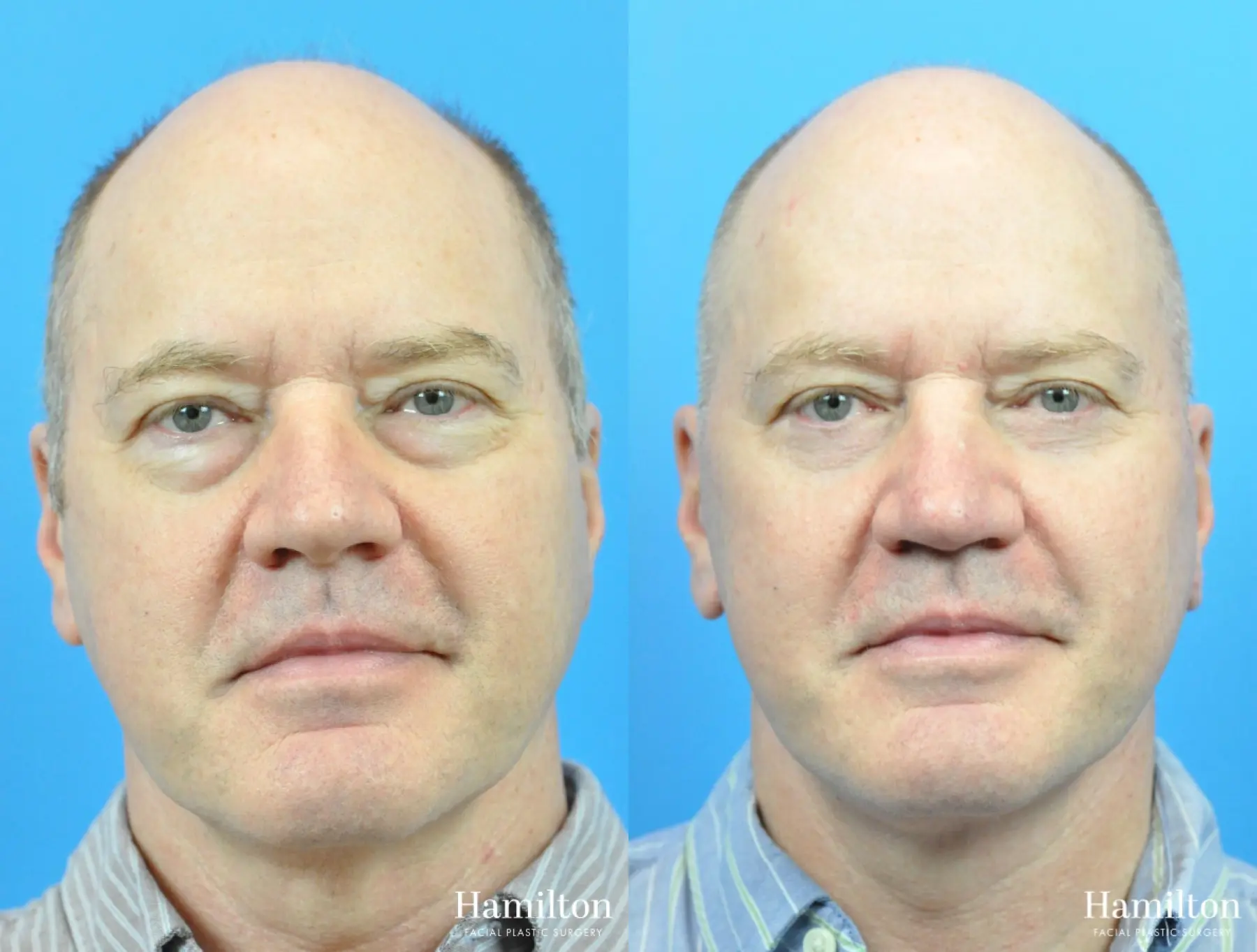 Facelift: Patient 33 - Before and After 2