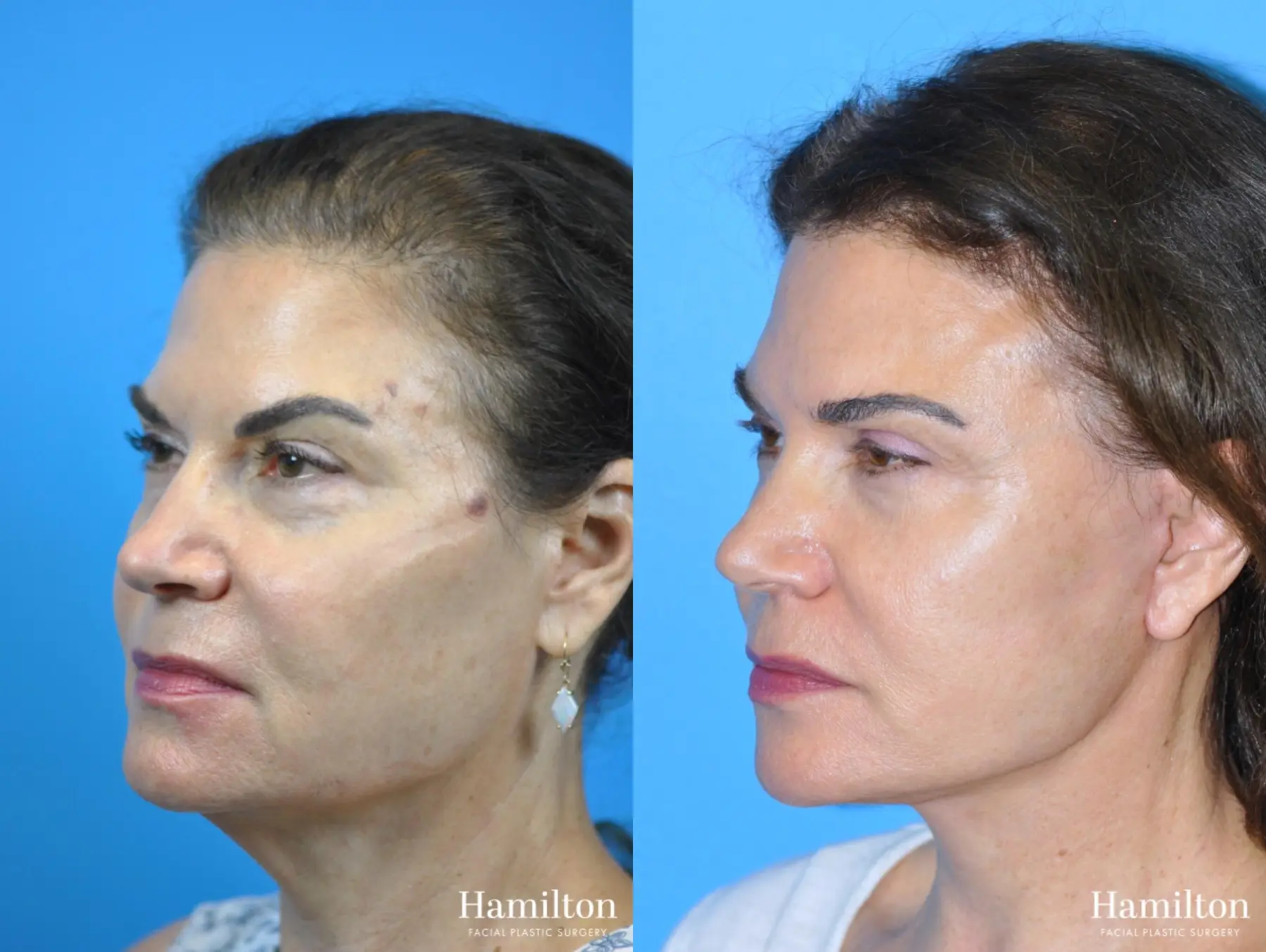 Facelift: Patient 2 - Before and After 3