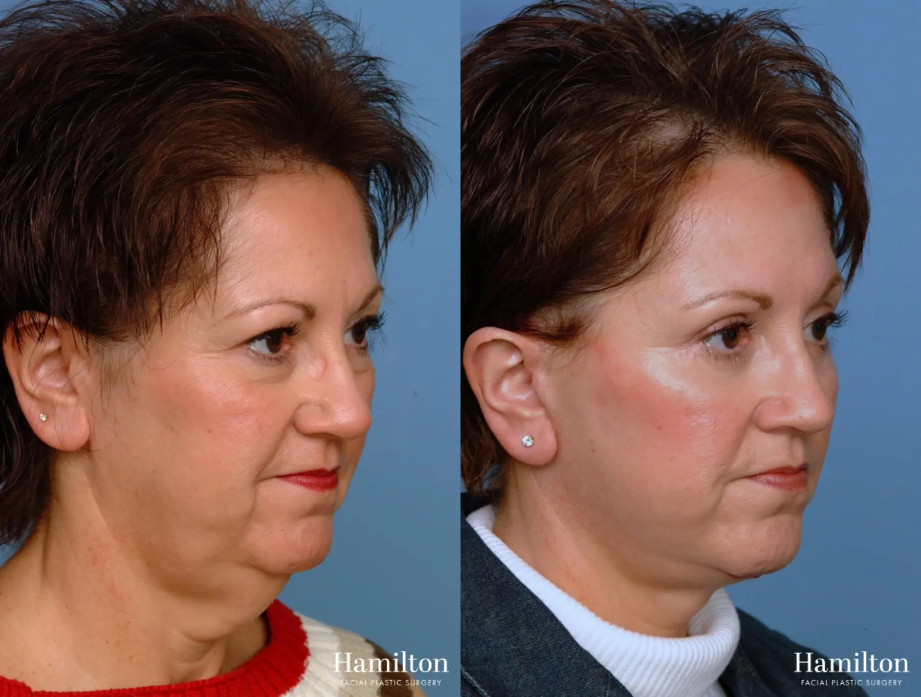 Facelift: Patient 13 - Before and After 2