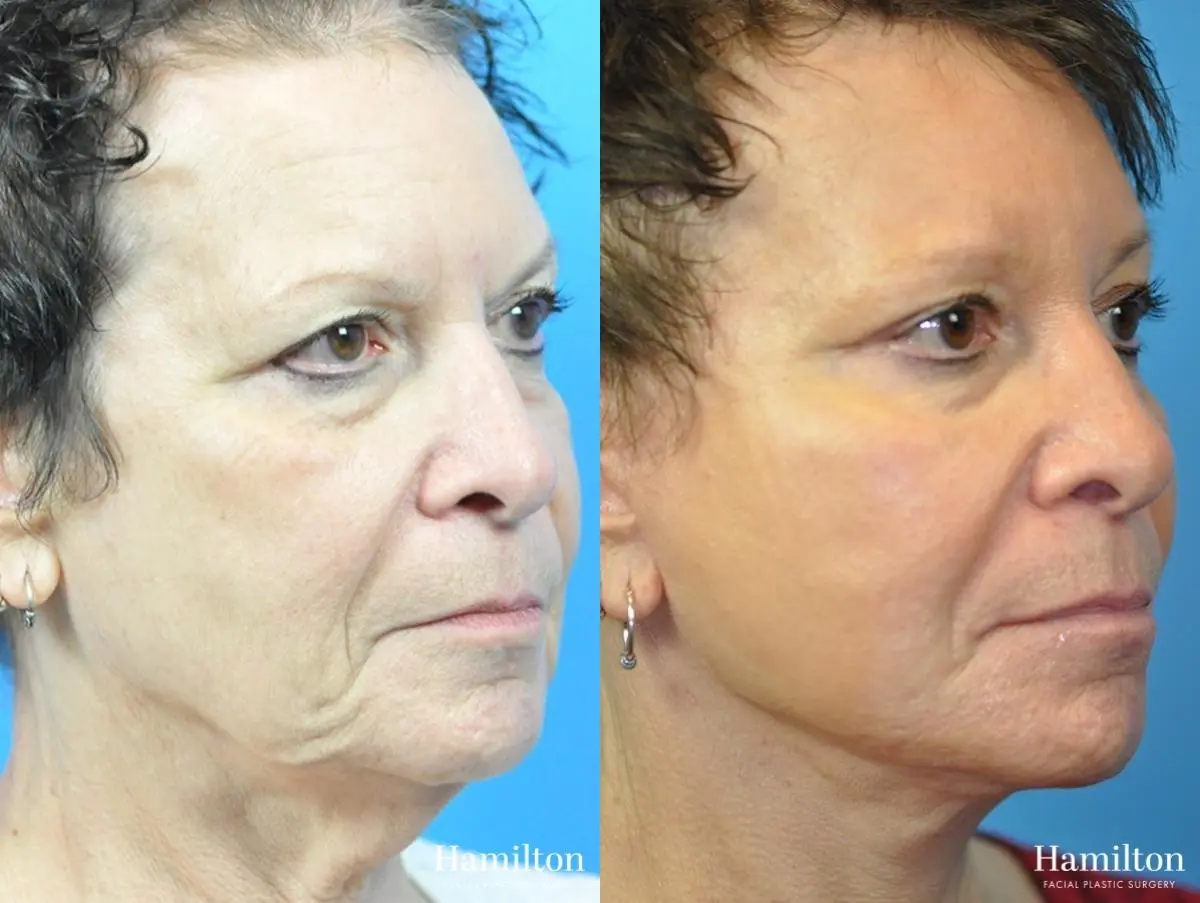 Facelift: Patient 28 - Before and After 2