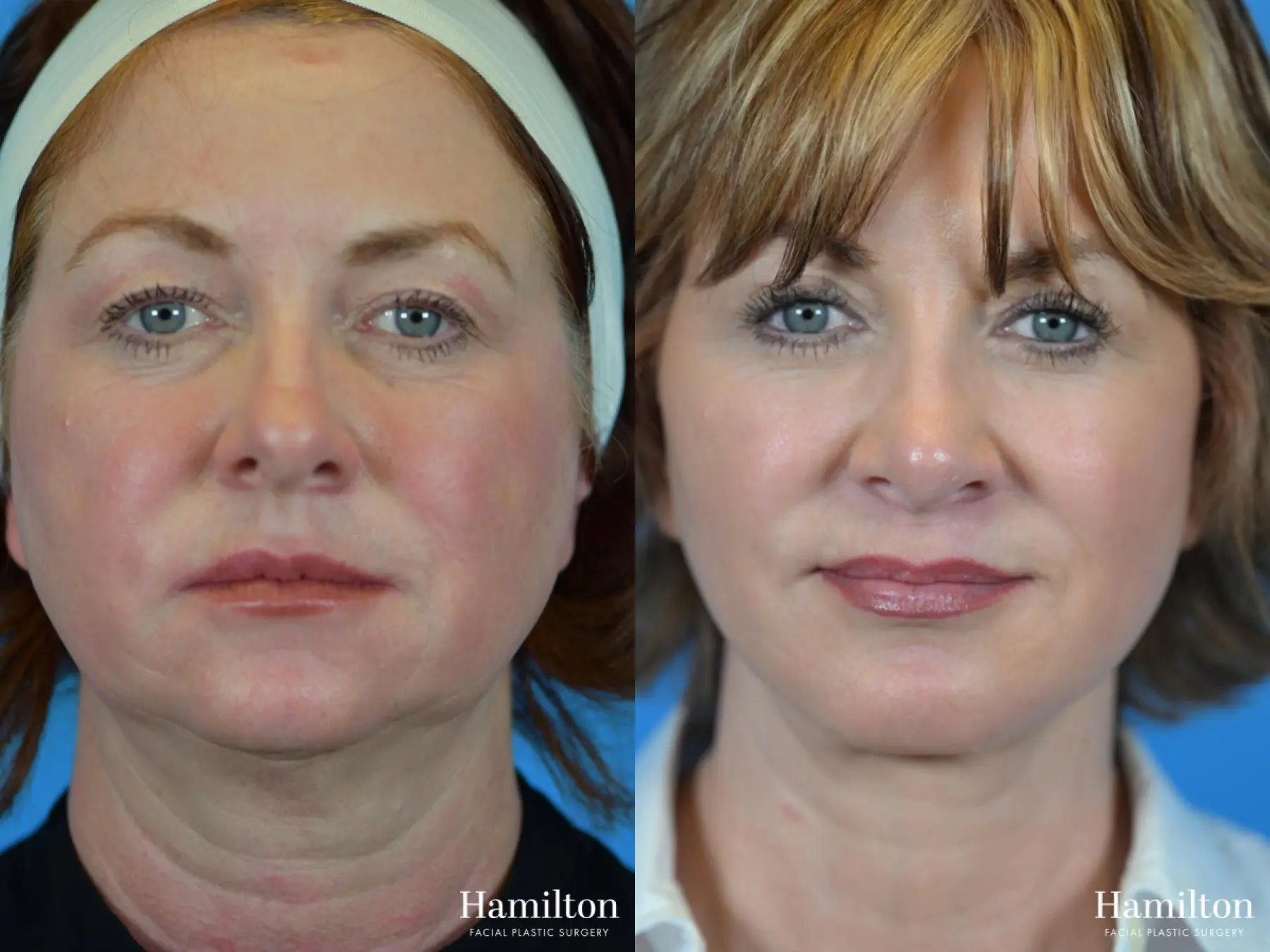 Facelift: Patient 1 - Before and After 2