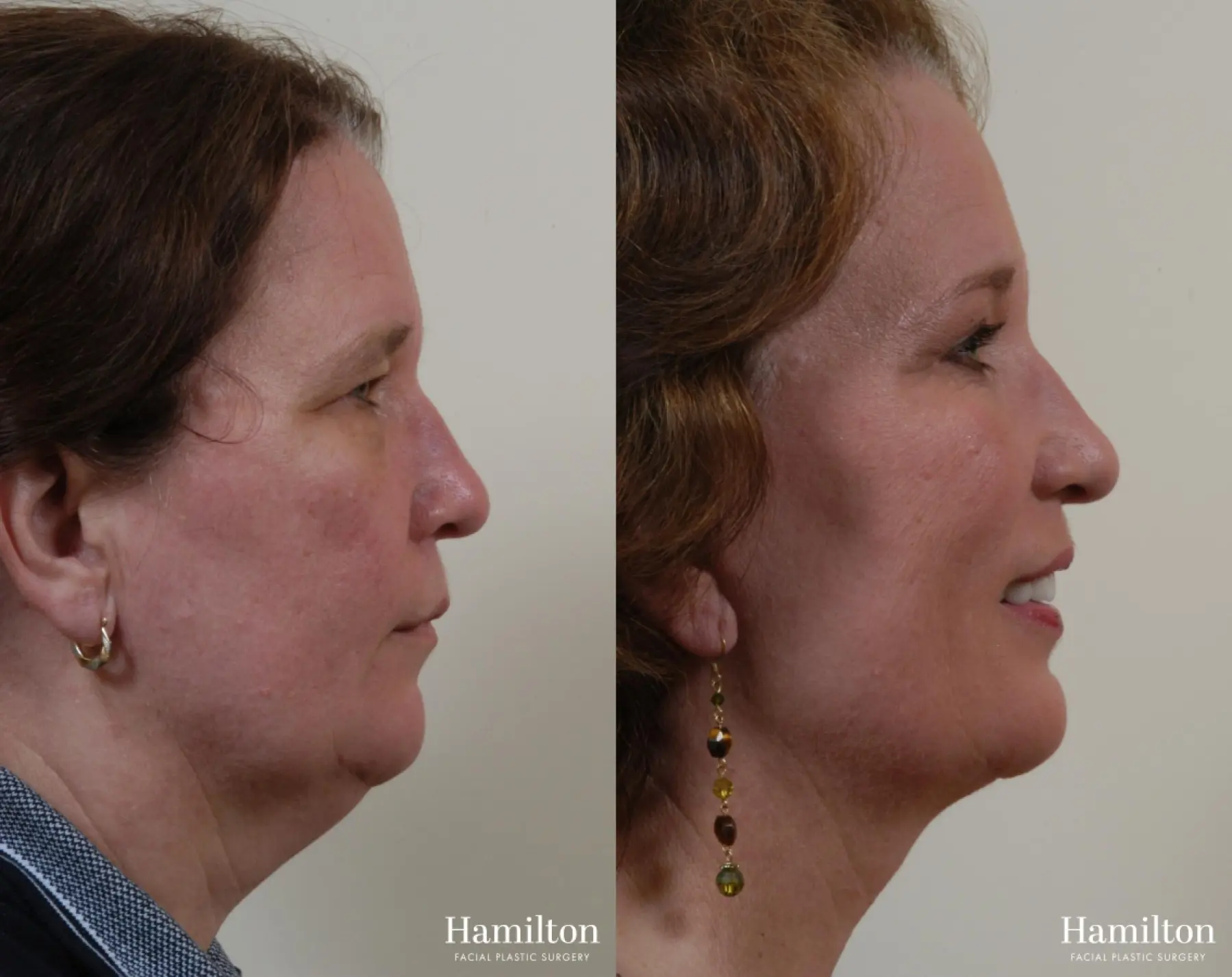 Facelift: Patient 6 - Before and After 2