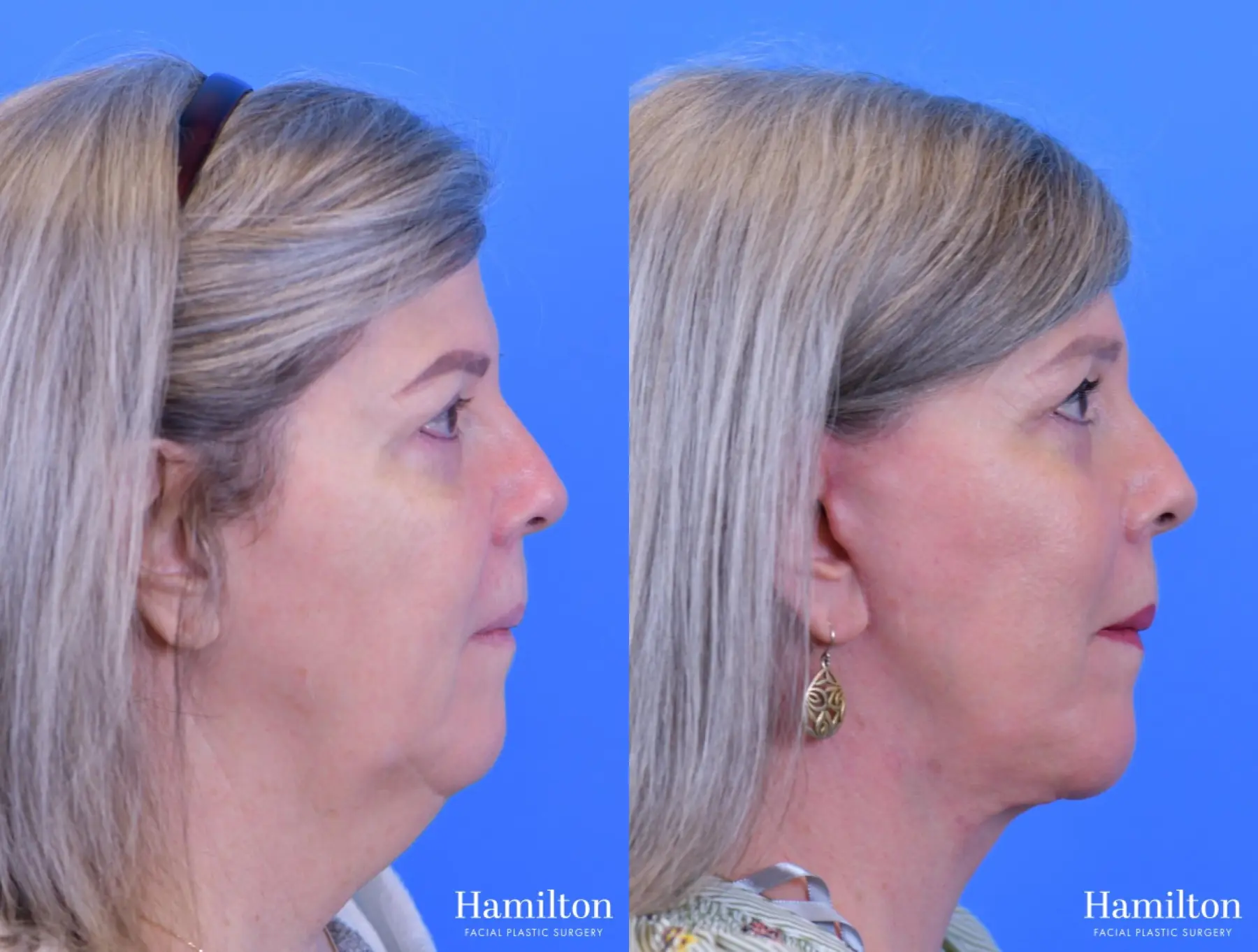 Facelift: Patient 8 - Before and After  