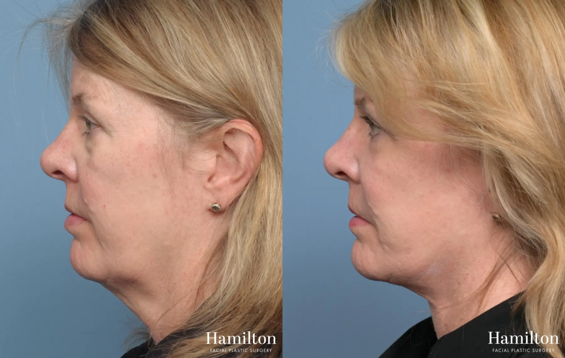 Facelift: Patient 43 - Before and After 5