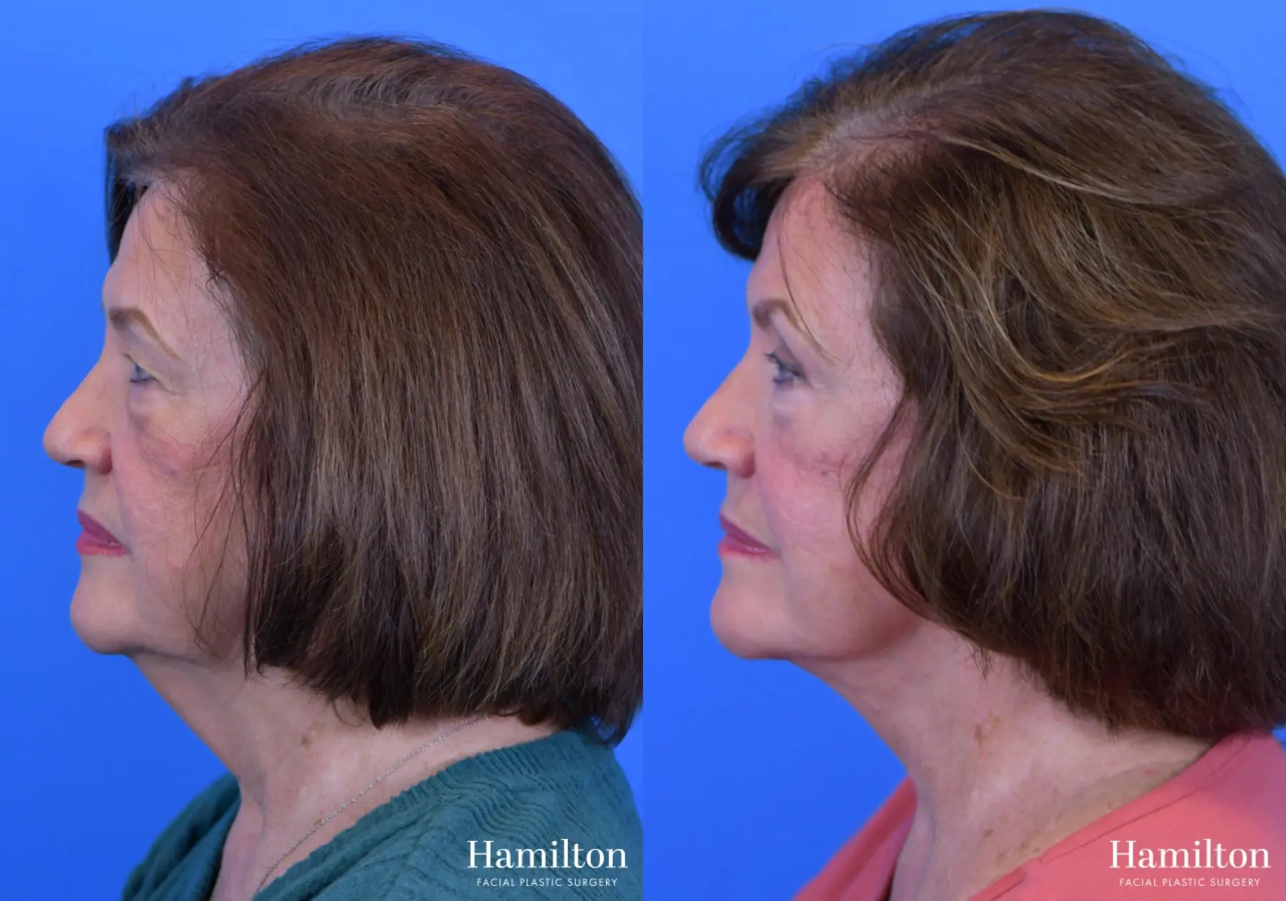 Facelift: Patient 16 - Before and After 1