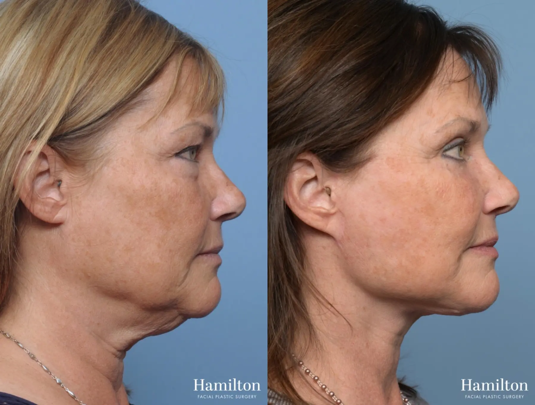 Facelift: Patient 14 - Before and After 3