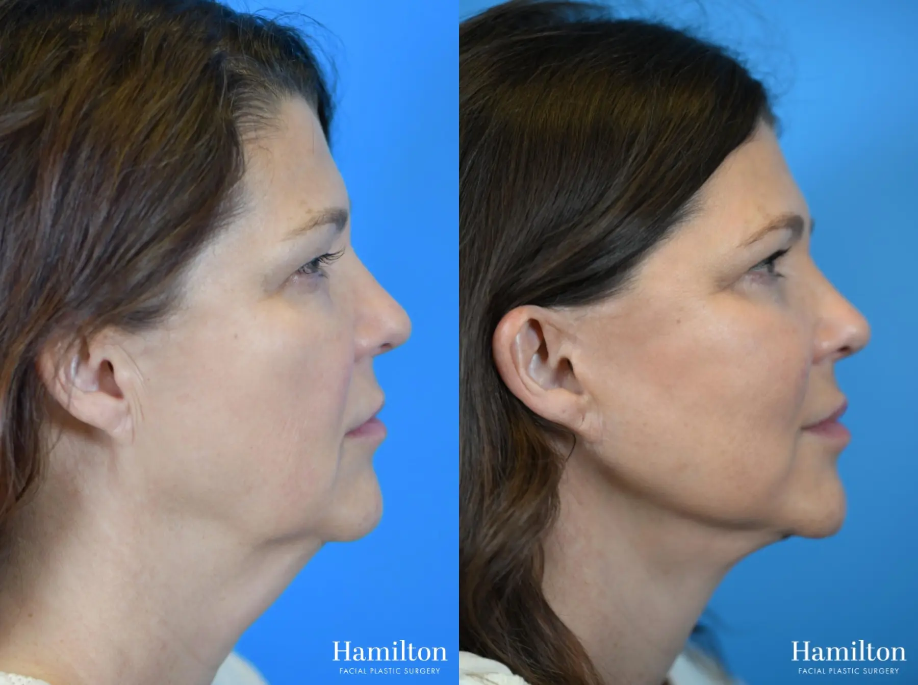 Facelift: Patient 15 - Before and After 1