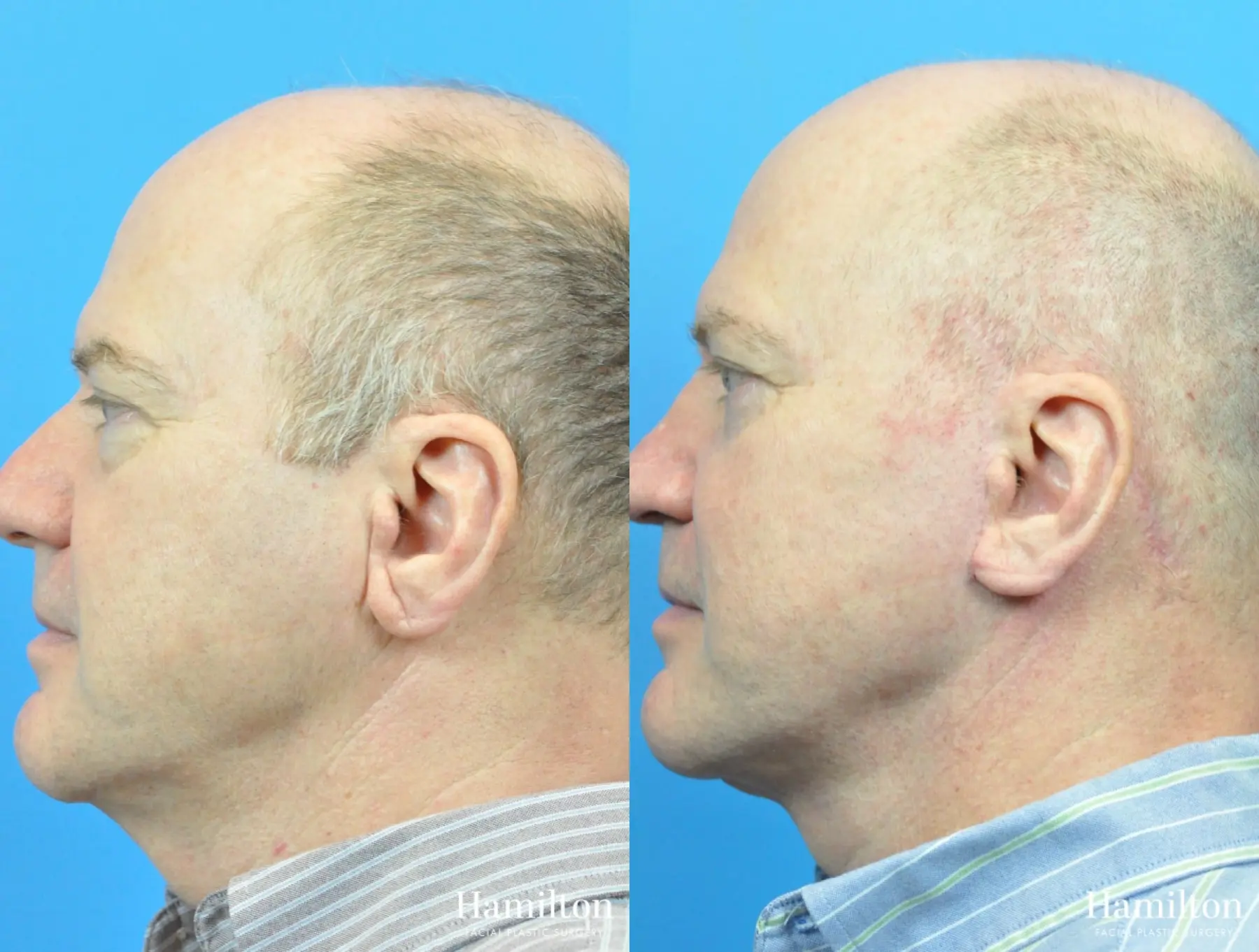 Facelift: Patient 33 - Before and After 3