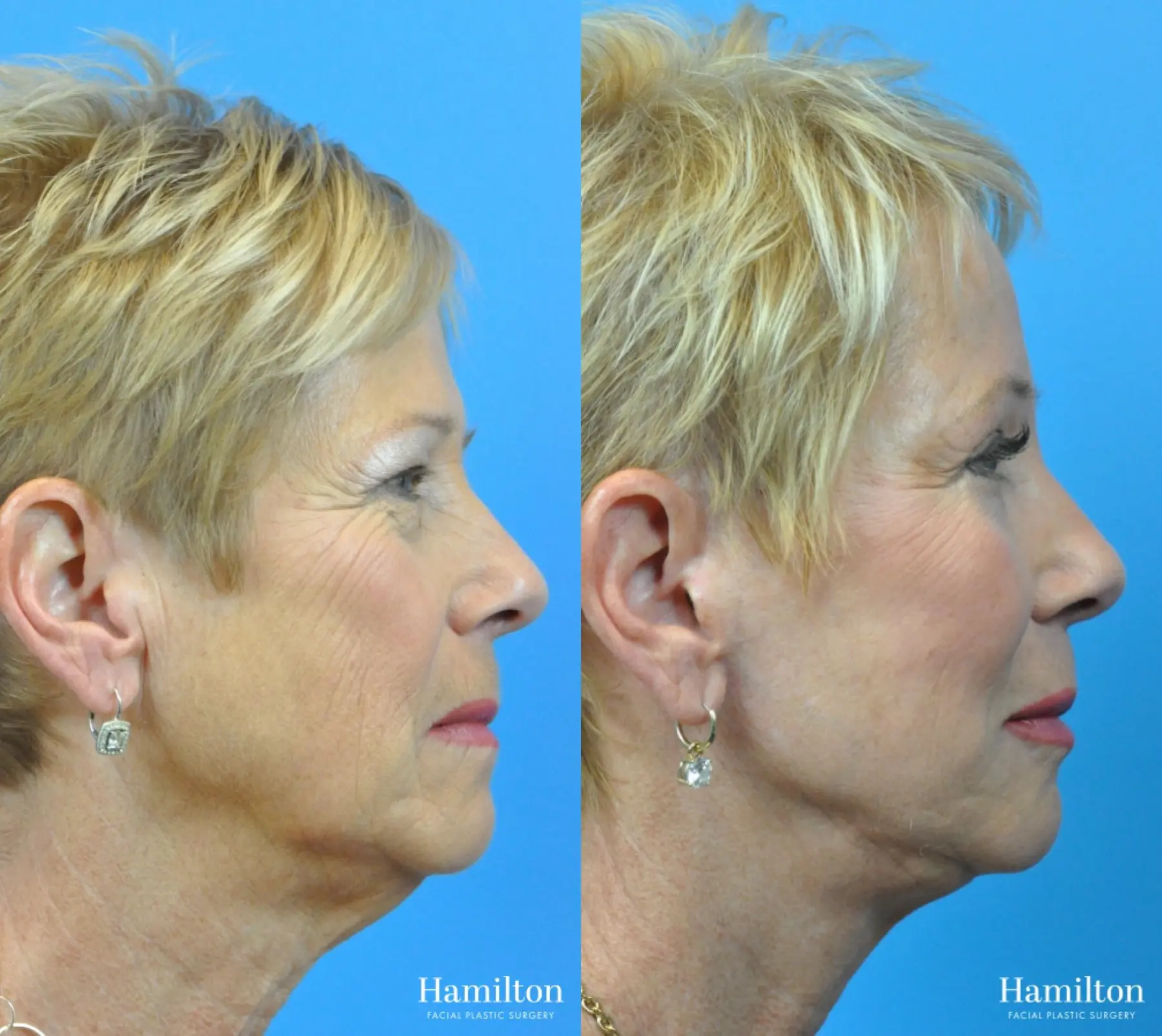 Facelift: Patient 11 - Before and After 3