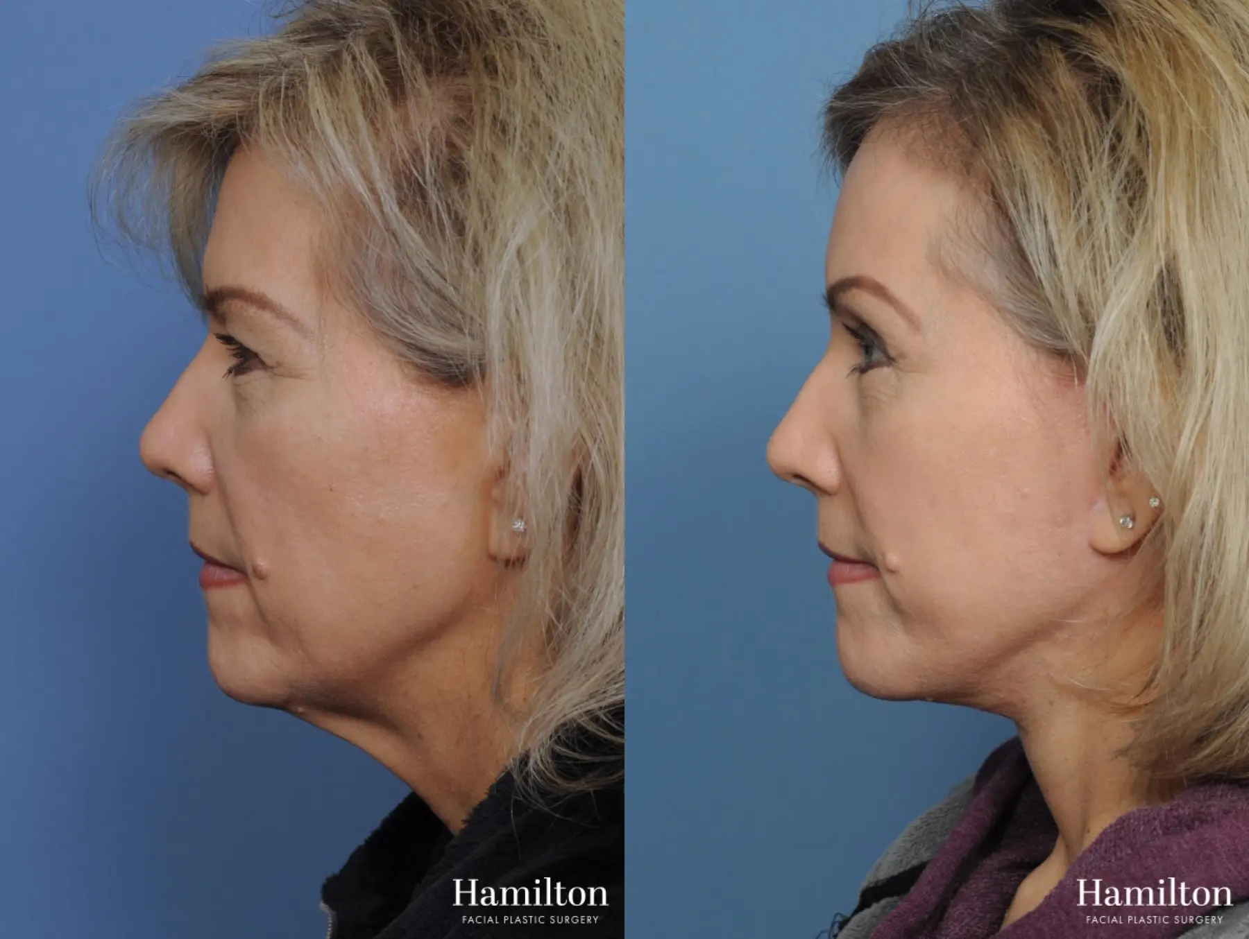 Facelift: Patient 3 - Before and After 2