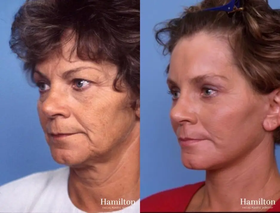 Facelift: Patient 27 - Before and After 2