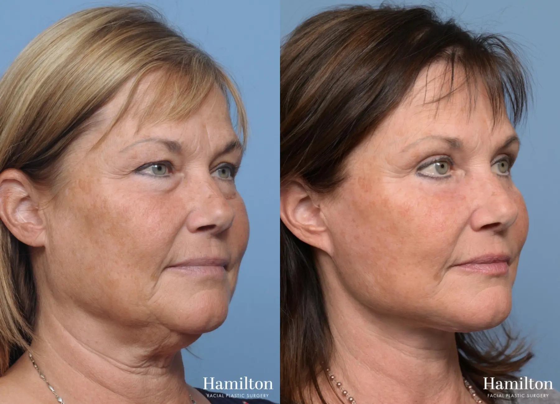 Facelift: Patient 14 - Before and After 1