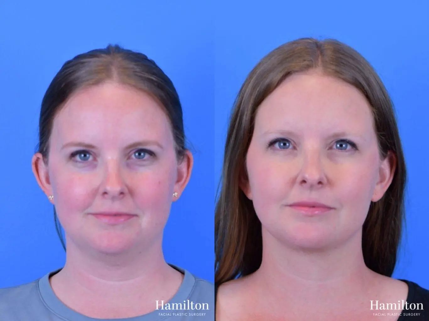 FaceTite: Patient 2 - Before and After  