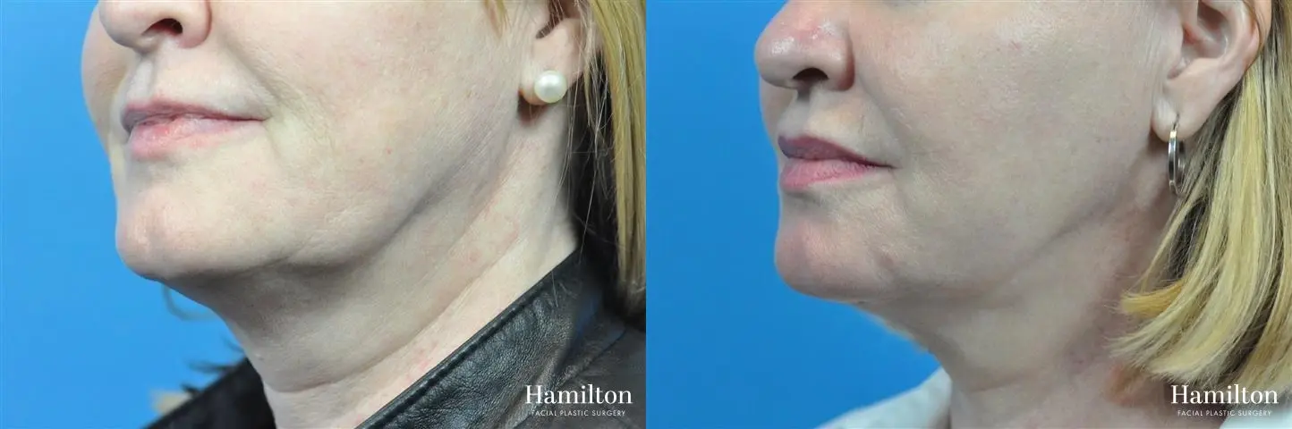 FaceTite Before & After Gallery: Patient 4
