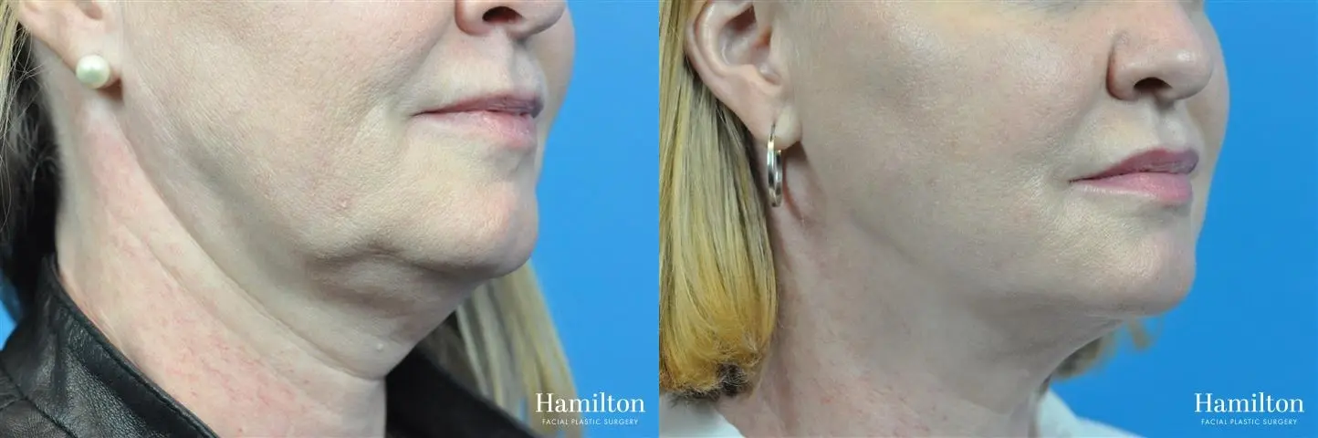 FaceTite: Patient 4 - Before and After 2