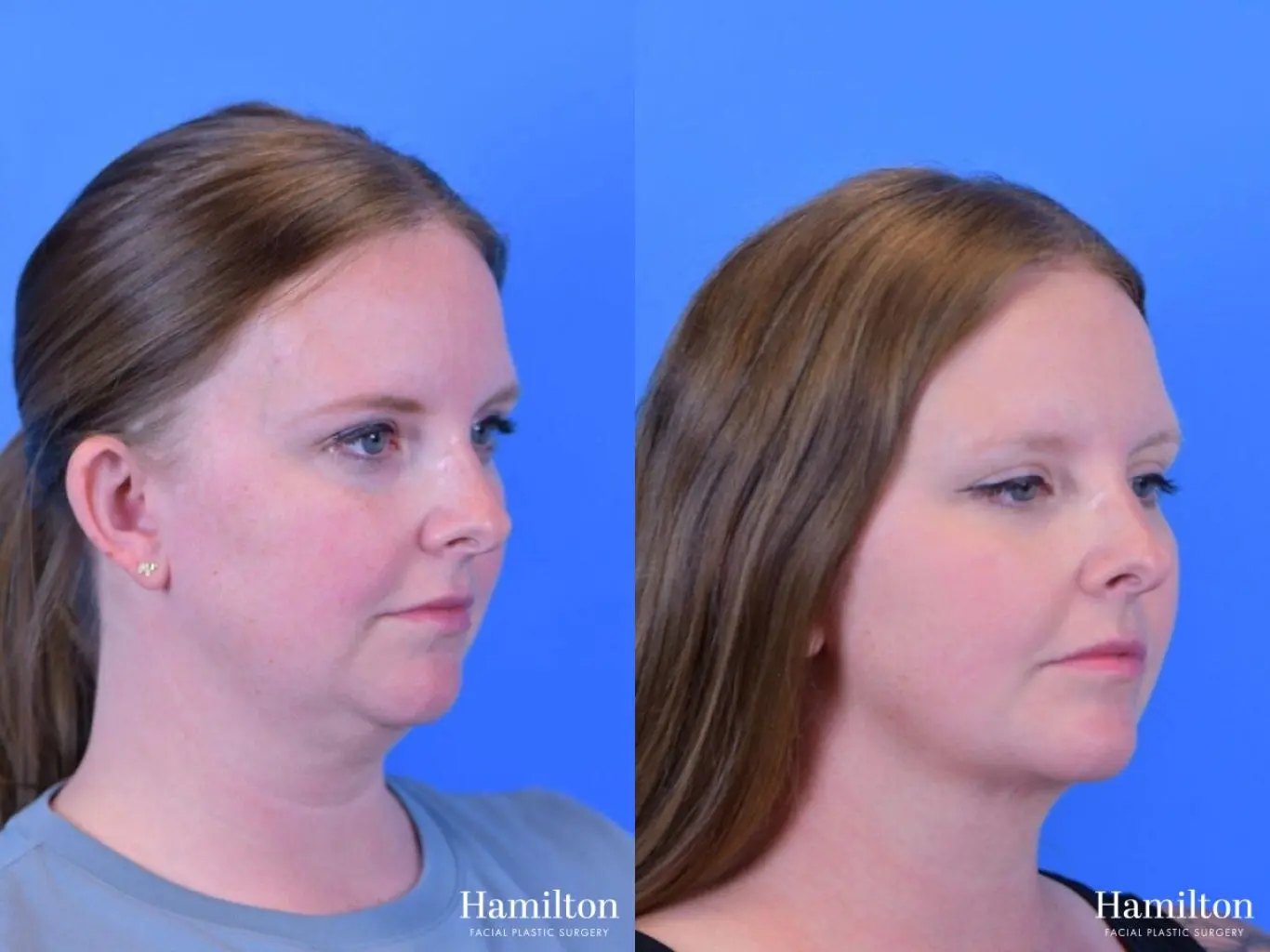 FaceTite: Patient 2 - Before and After 4
