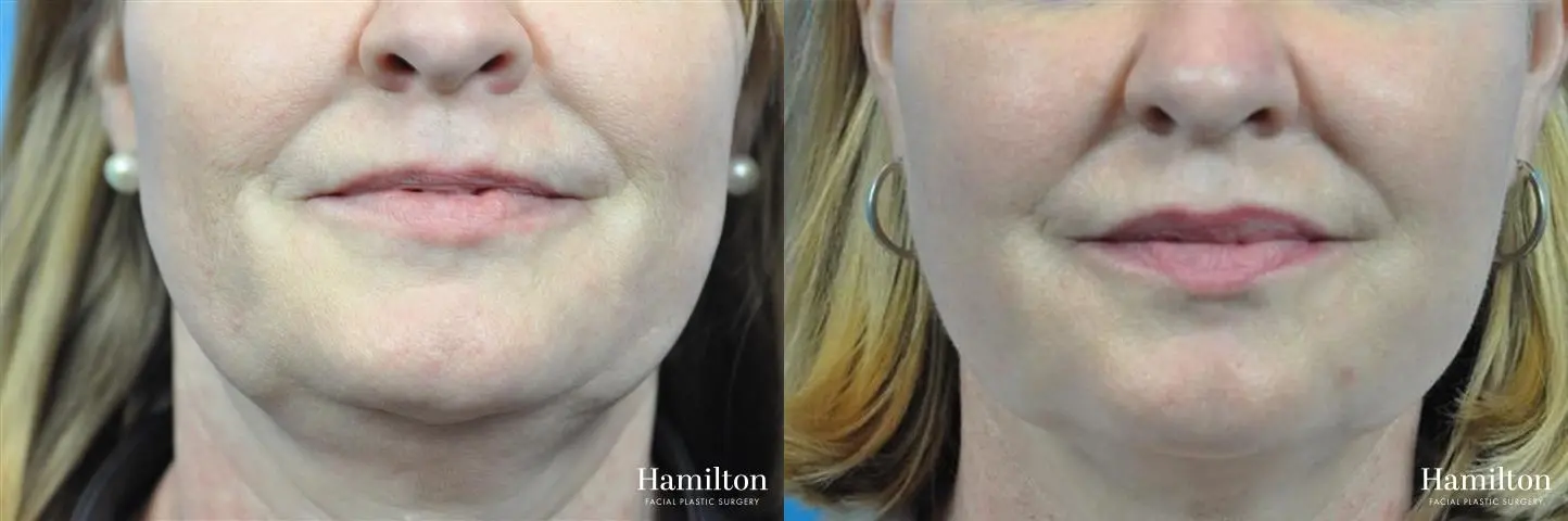 FaceTite: Patient 4 - Before and After