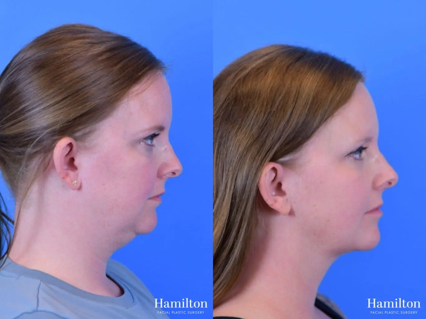 FaceTite: Patient 2 - Before and After 5