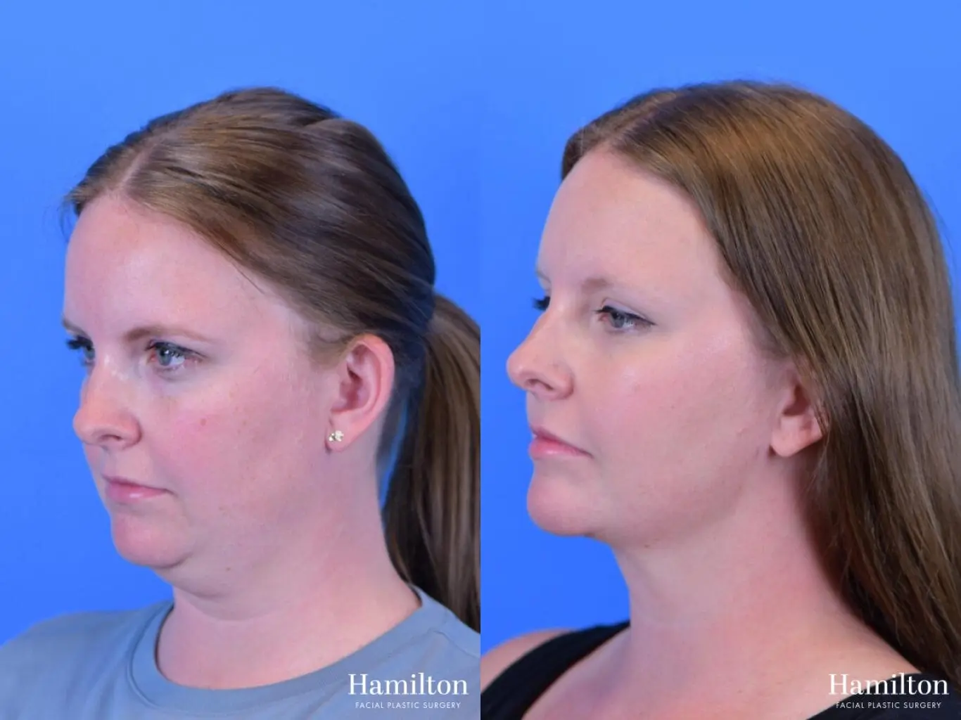 FaceTite: Patient 2 - Before and After 2