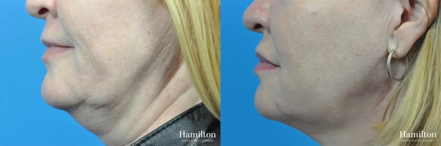 FaceTite Before & After Gallery: Patient 4