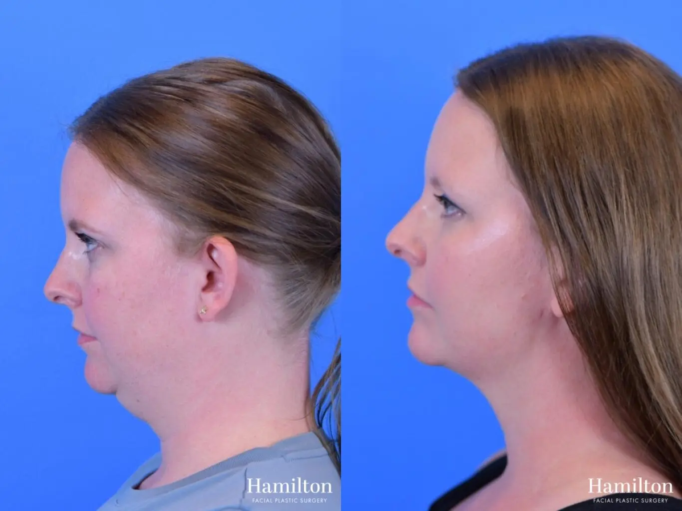 FaceTite: Patient 2 - Before and After 3