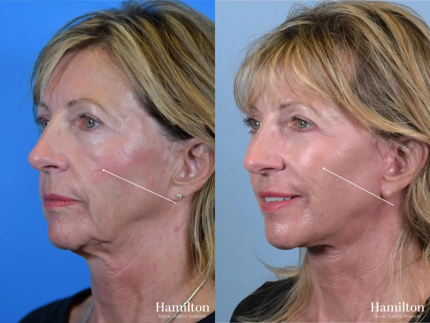 Fat Grafting: Patient 4 - Before and After  
