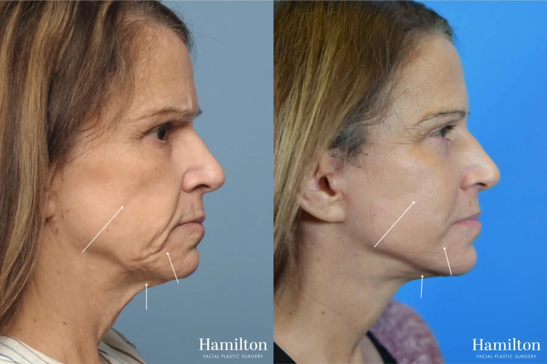 Fat Grafting: Patient 5 - Before and After  