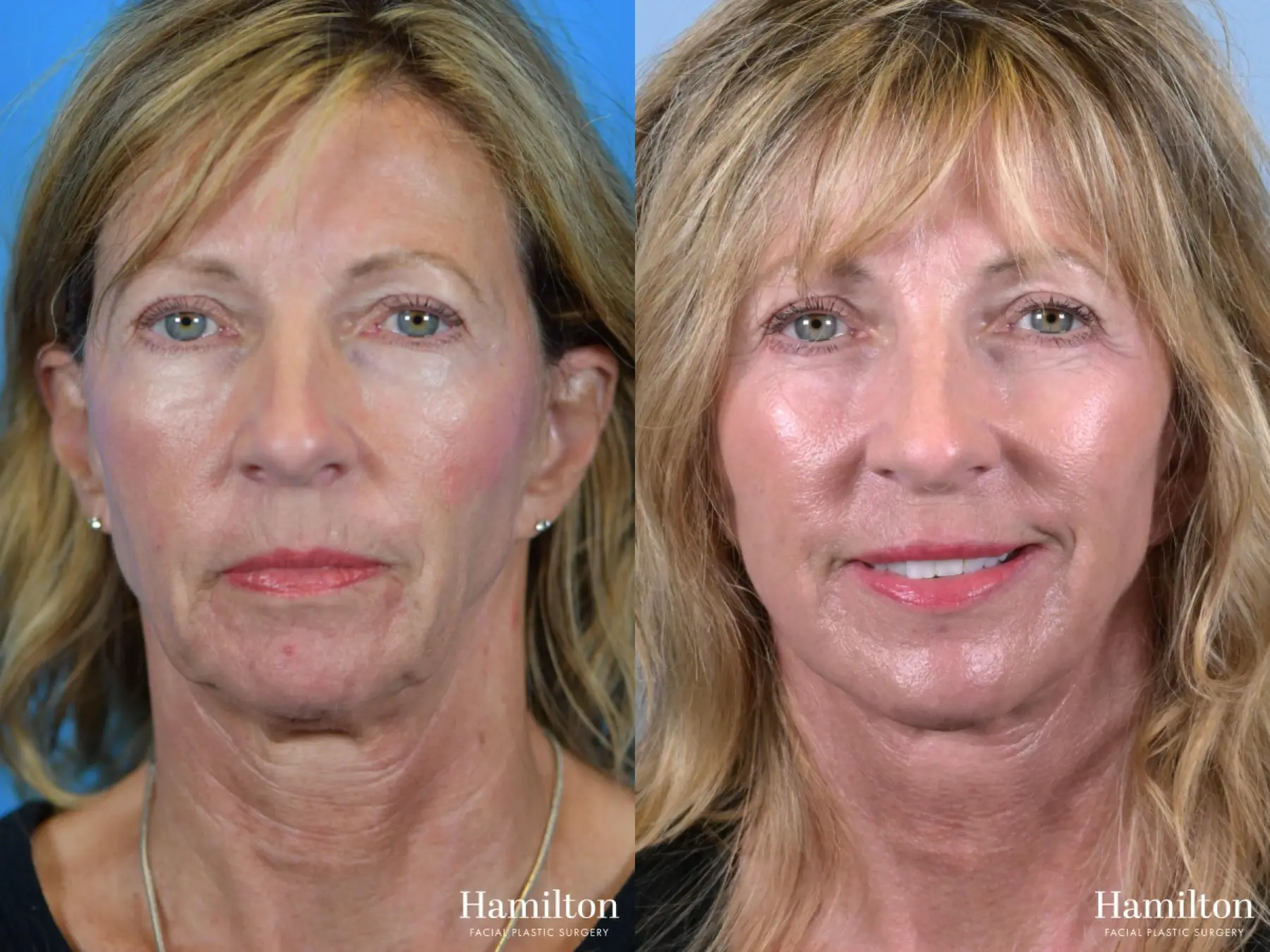 Fat Grafting: Patient 4 - Before and After 5