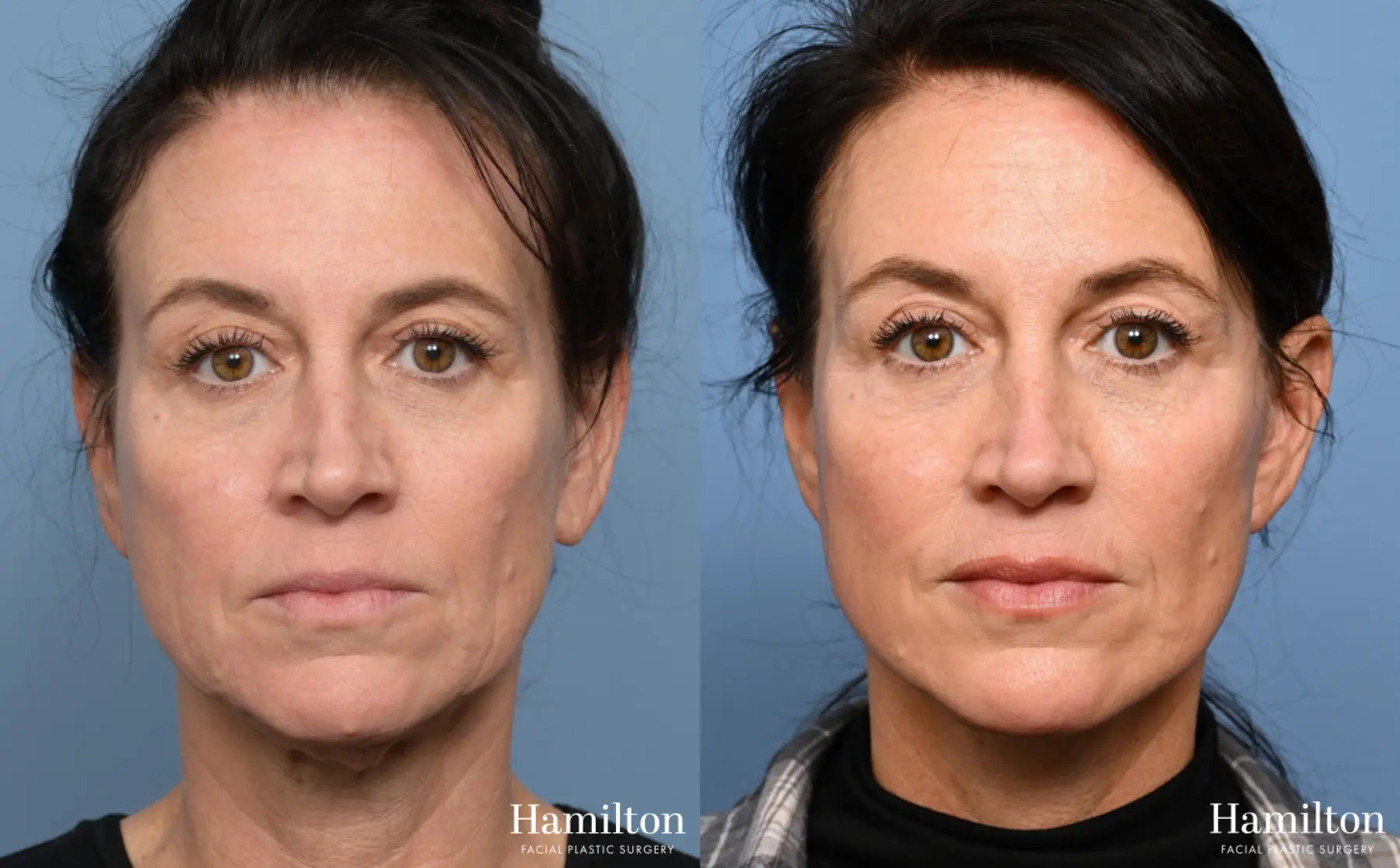 Fat Grafting: Patient 2 - Before and After 4