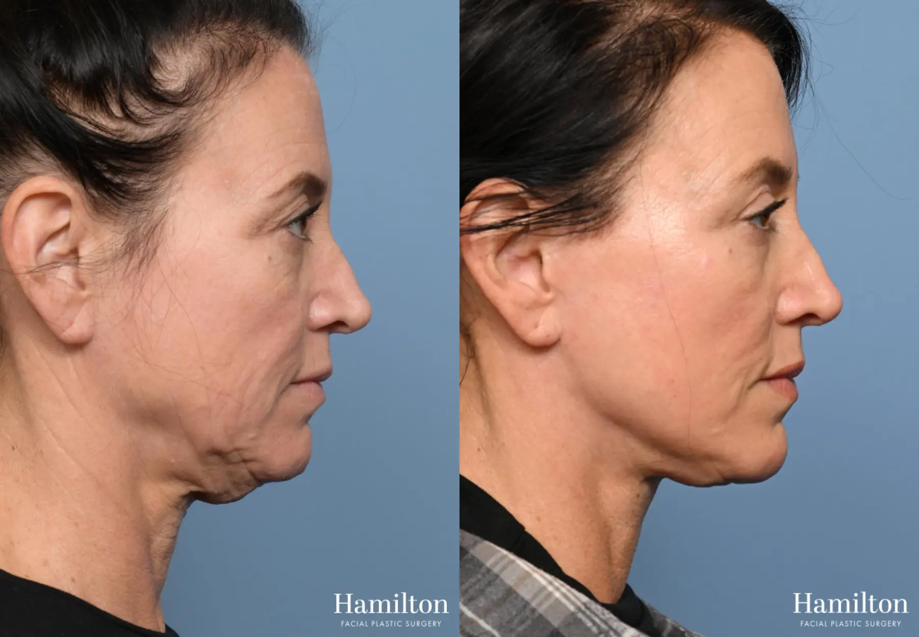 Fat Grafting: Patient 2 - Before and After 2