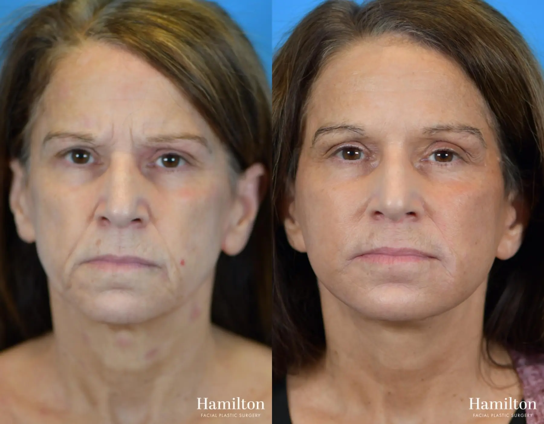 Fat Grafting: Patient 5 - Before and After 4