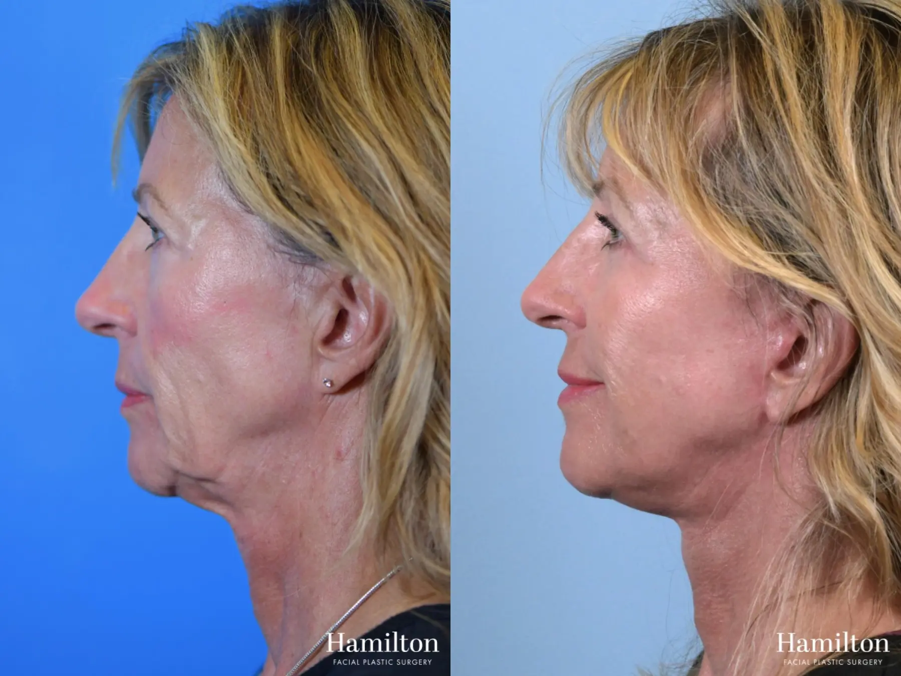 Fat Grafting: Patient 4 - Before and After 4