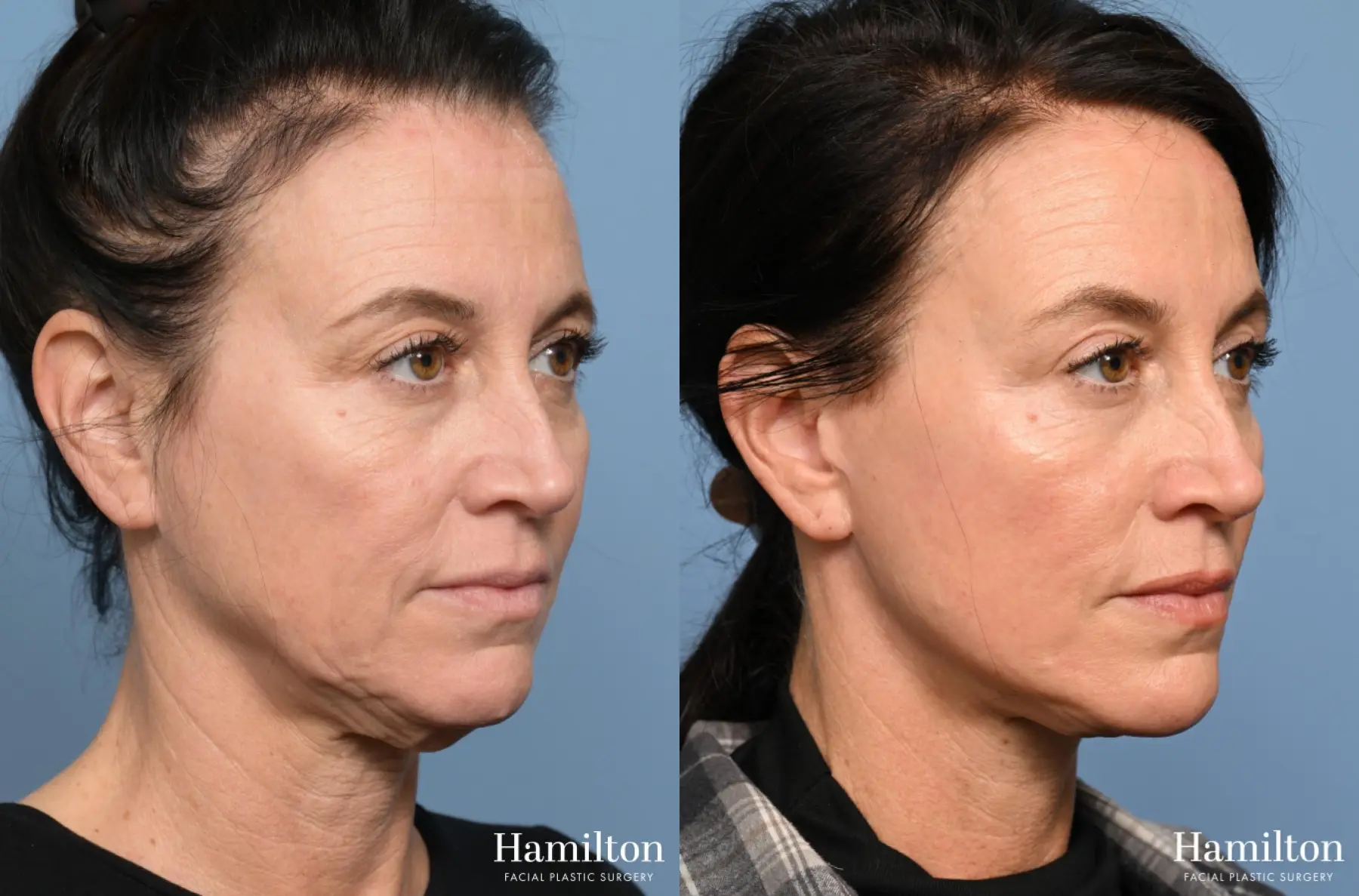 Fat Grafting: Patient 2 - Before and After 3