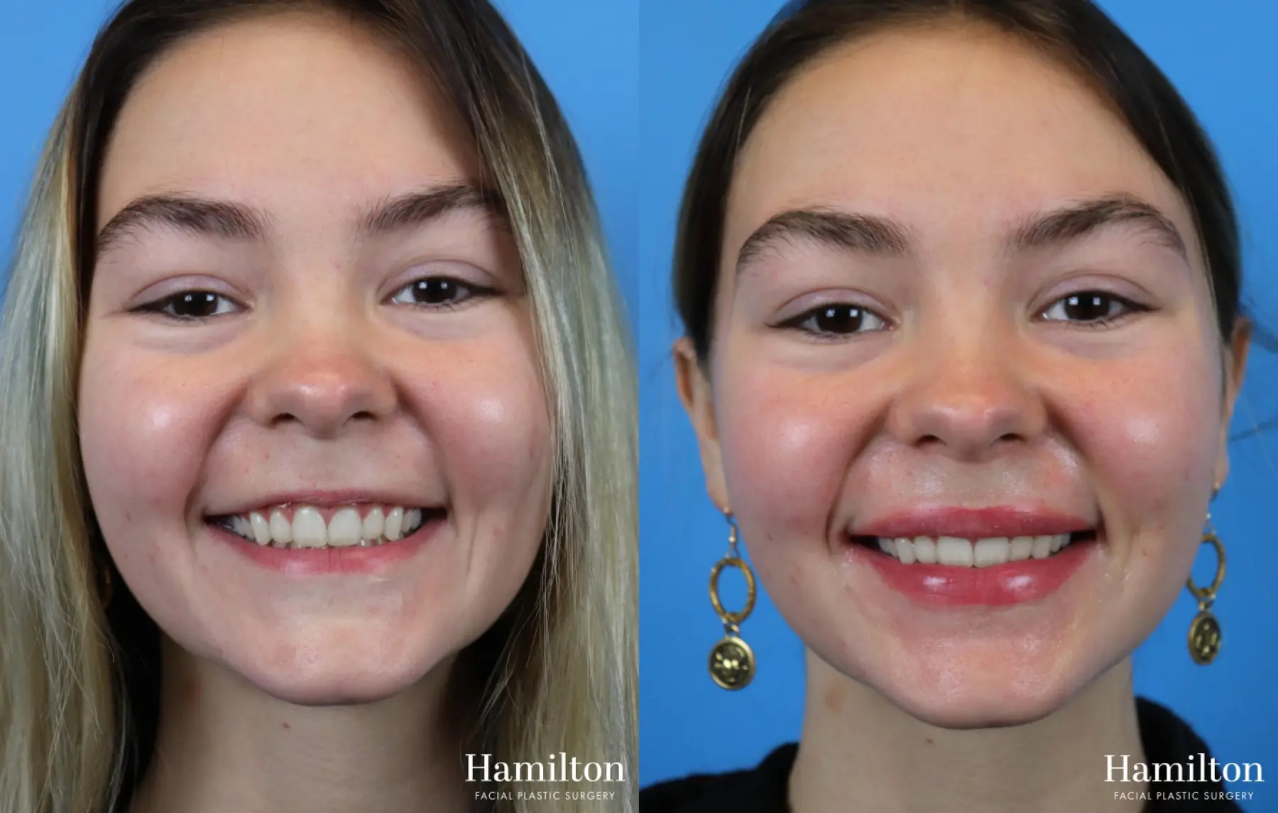 Fillers: Patient 1 - Before and After 1