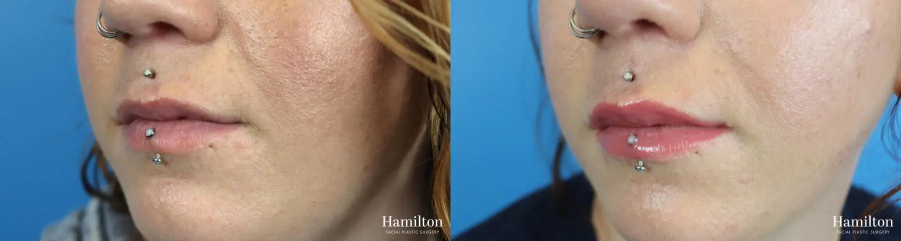Fillers: Patient 7 - Before and After 3